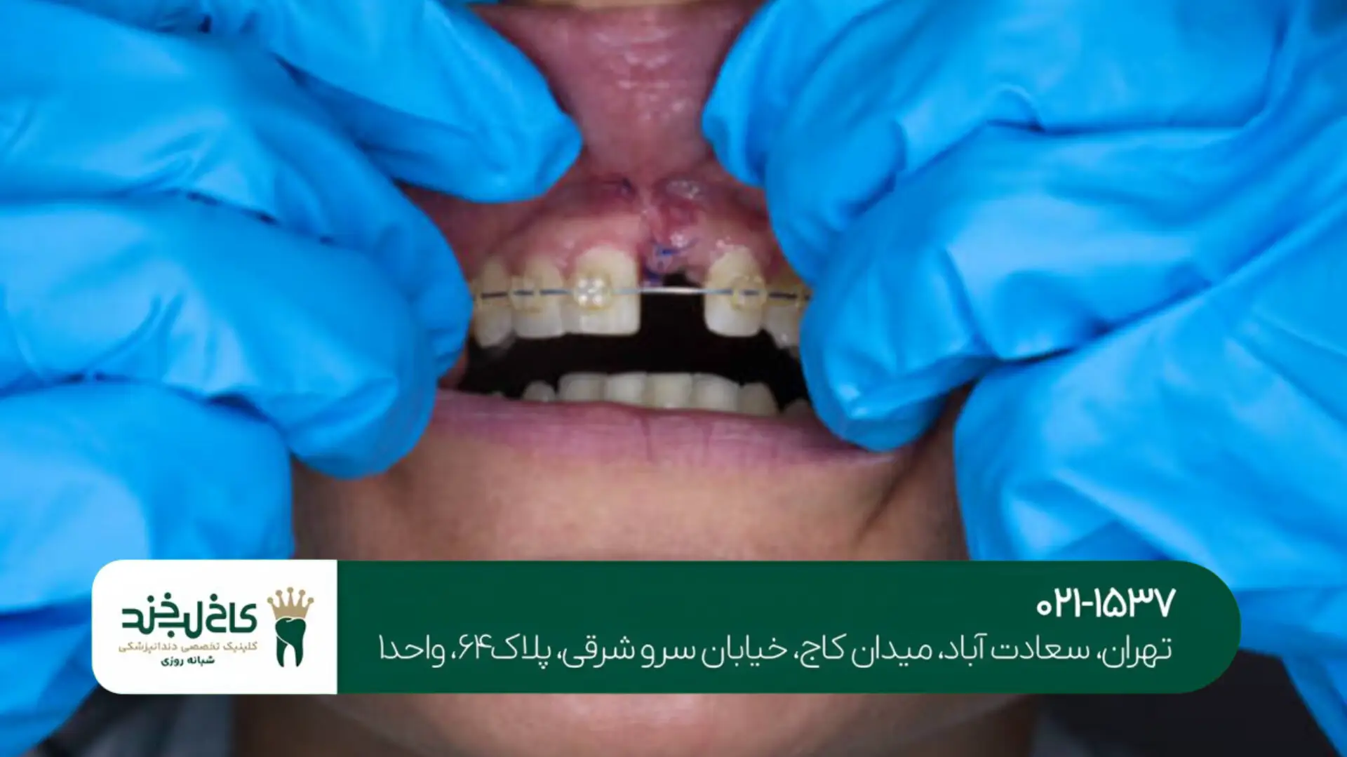 کاشت دندان بدون برش لثه