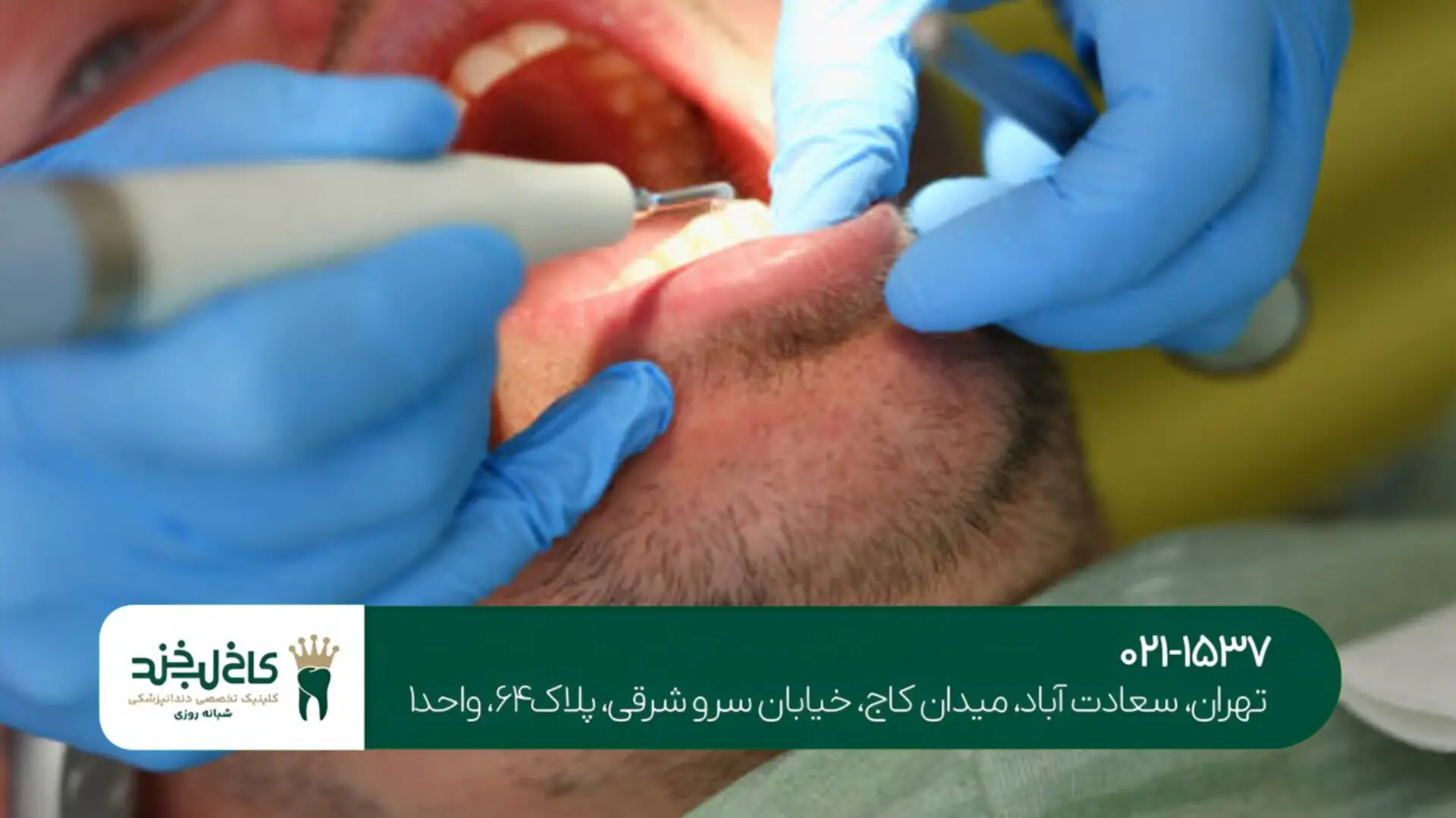 کاشت دندان بدون برش لثه