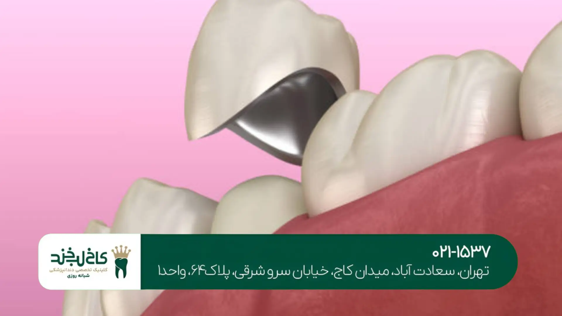 روکش دندان موقت تا دایمی