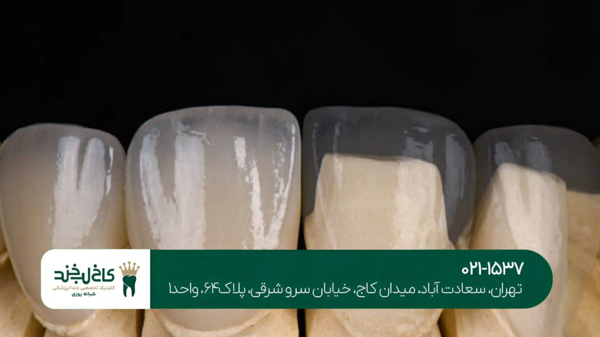 روکش دندان موقت تا دایمی