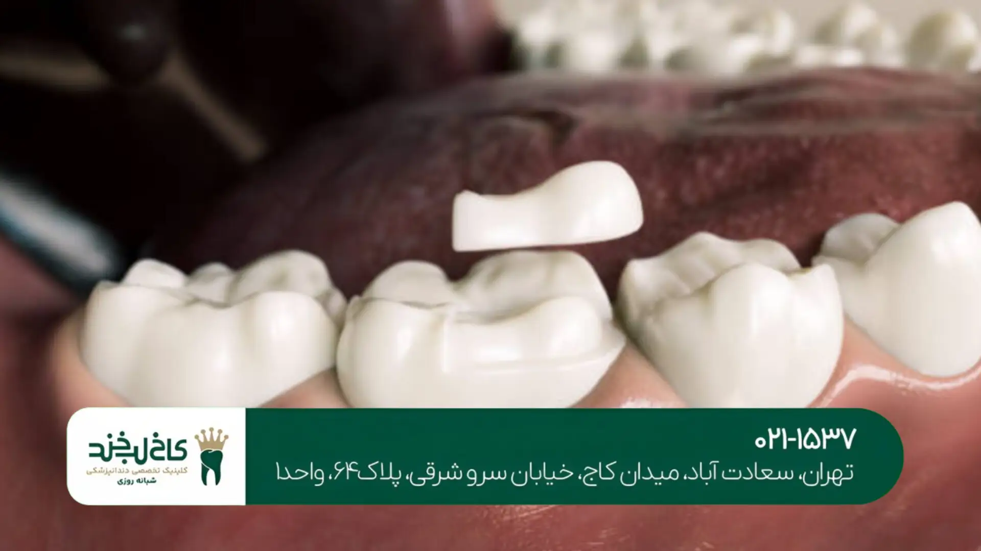 روکش دندان موقت تا دایمی