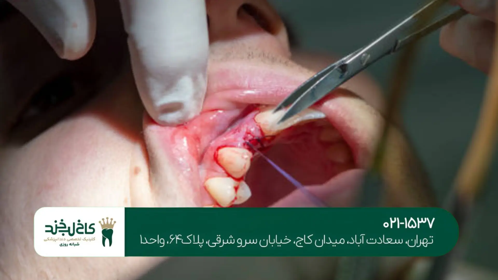 عصبکشی دندانهای عقبی