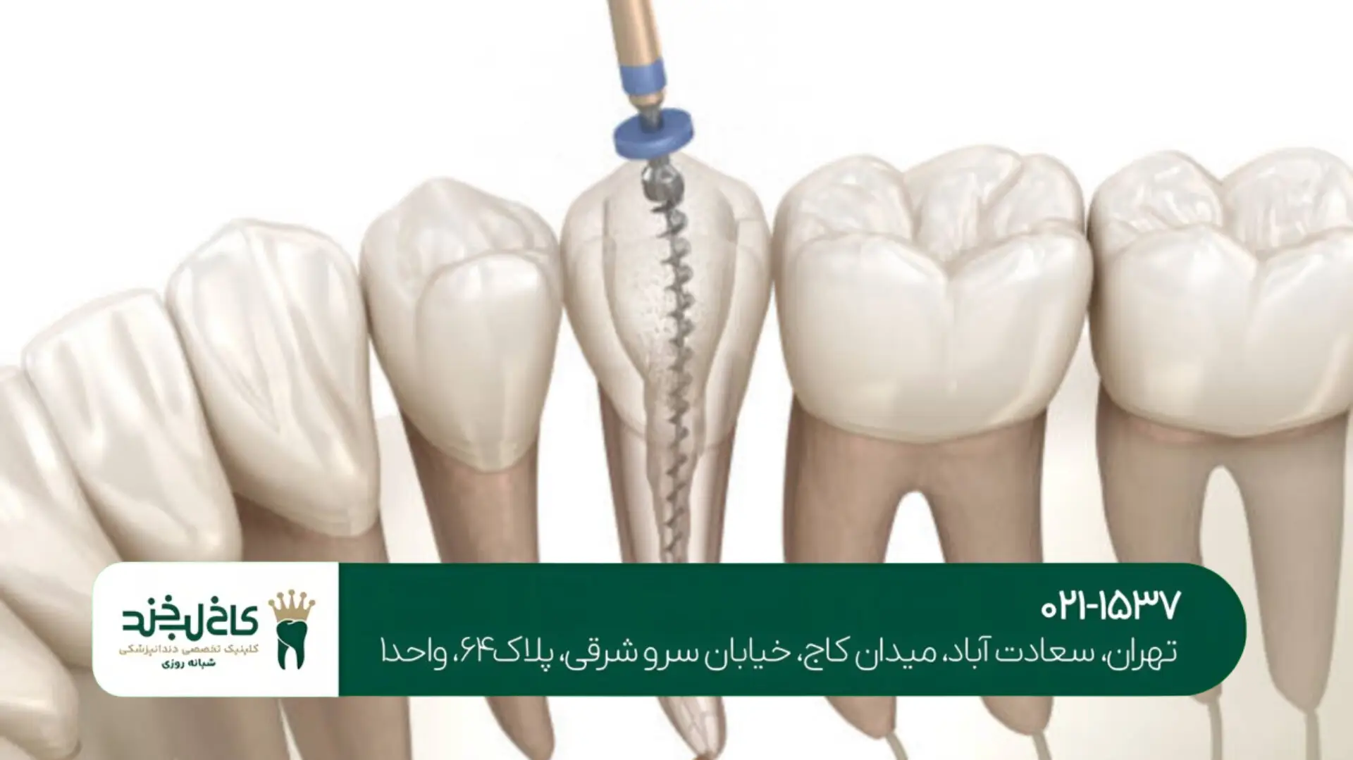 عصبکشی دندانهای عقبی