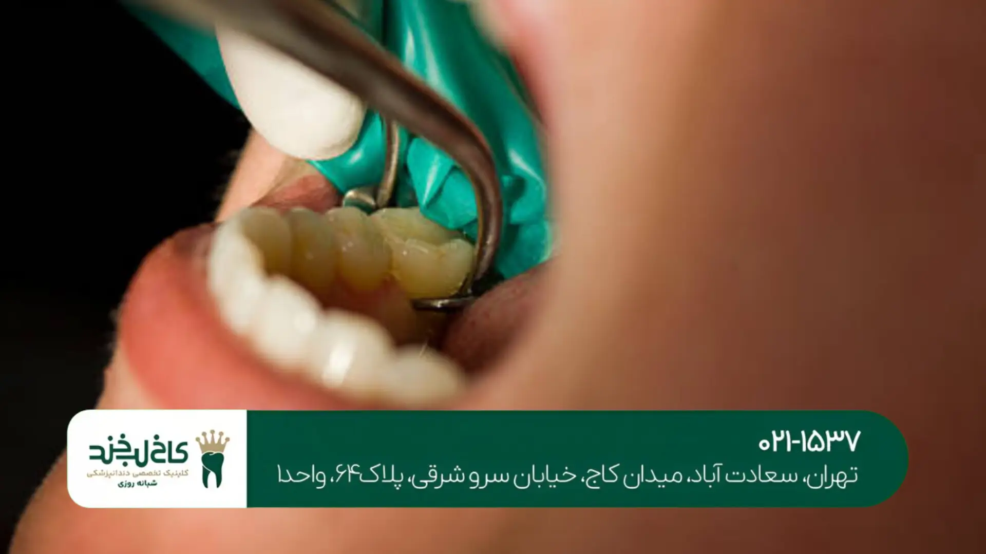 عصبکشی دندانهای عقبی