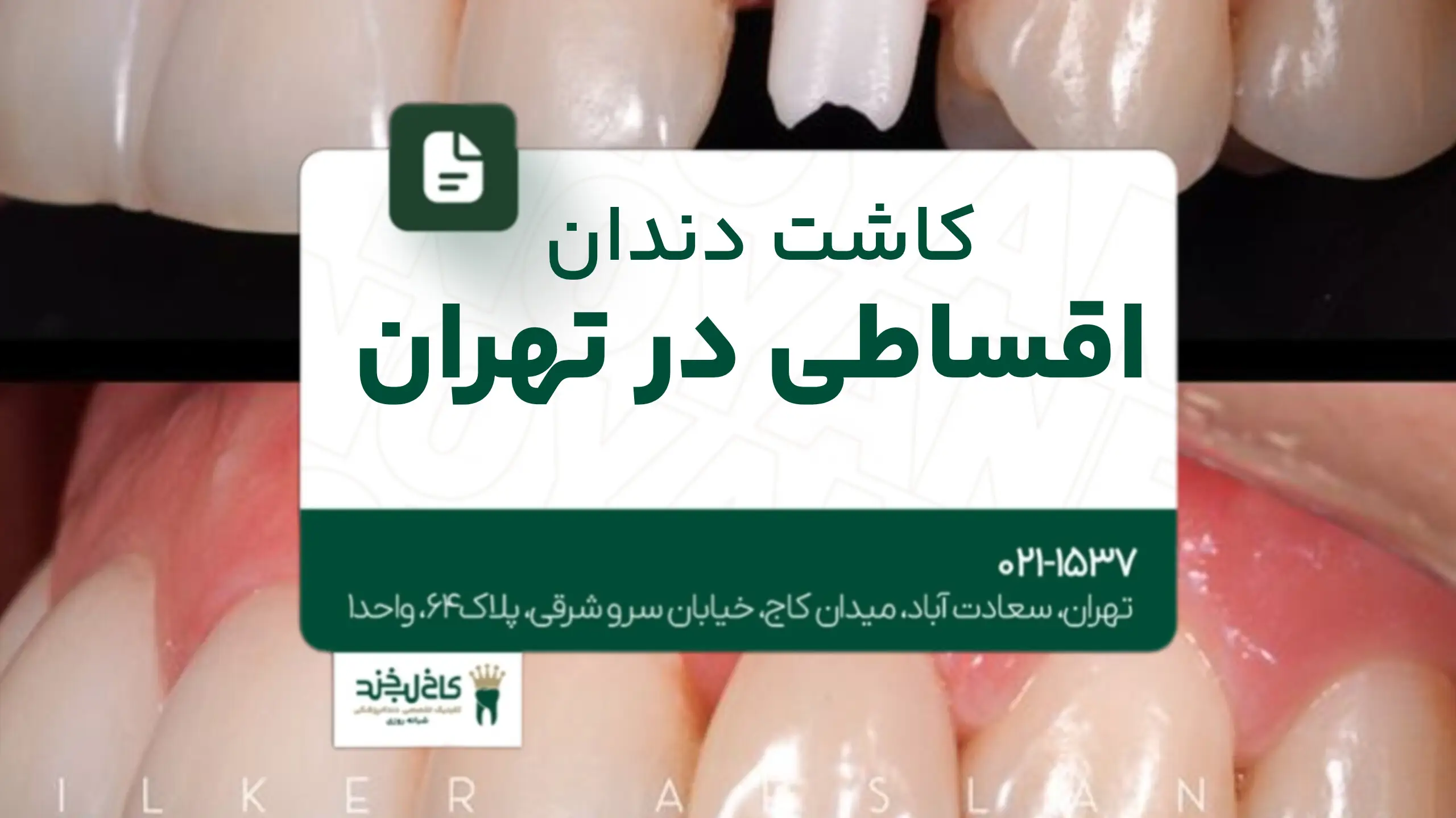 کاشت دندان اقساطی در تهران