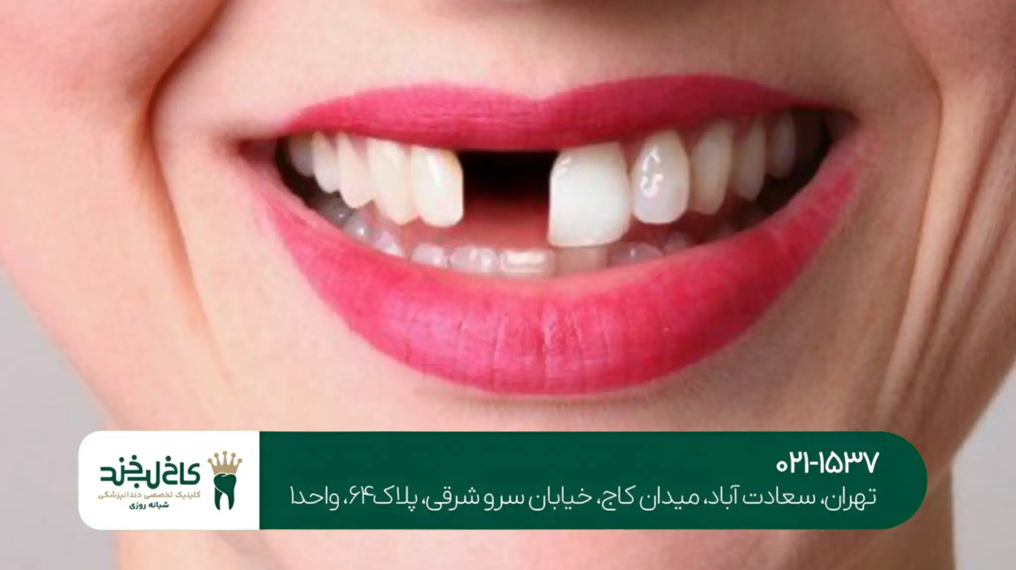 کاشت دندان اقساطی در تهران