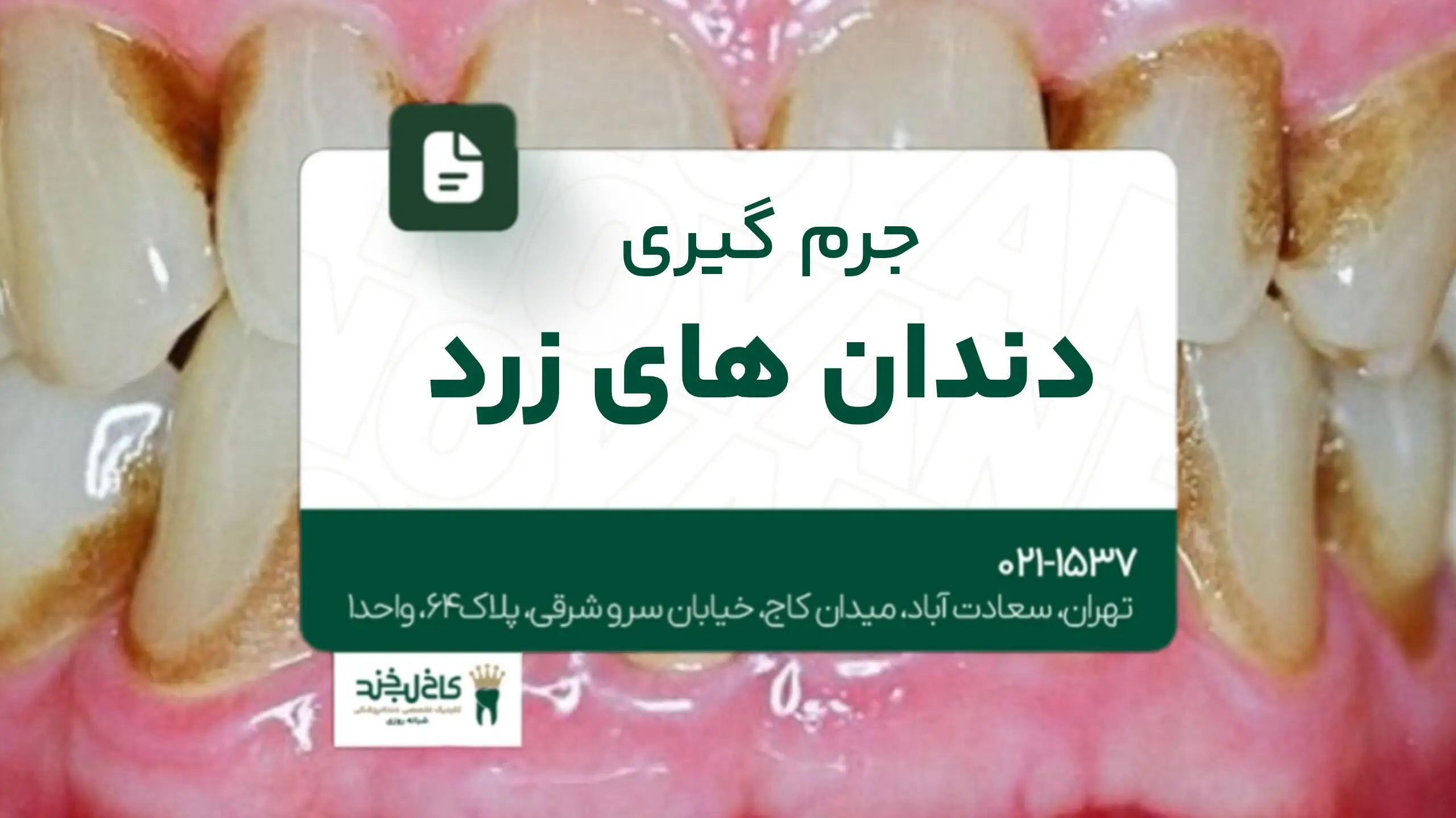 جرم‌گیری دندان‌های زرد