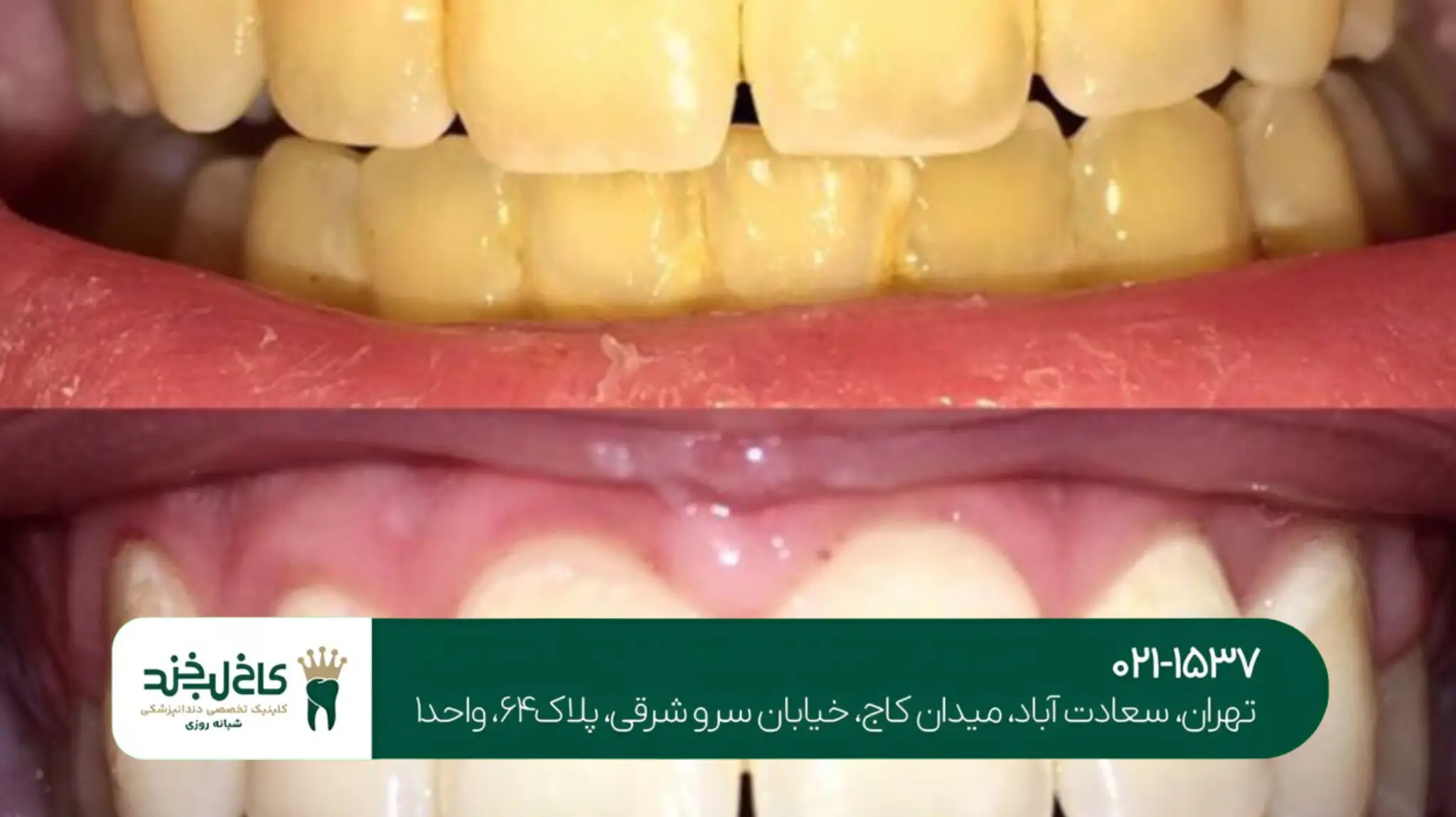 جراحی دندان عقل در شمال تهران