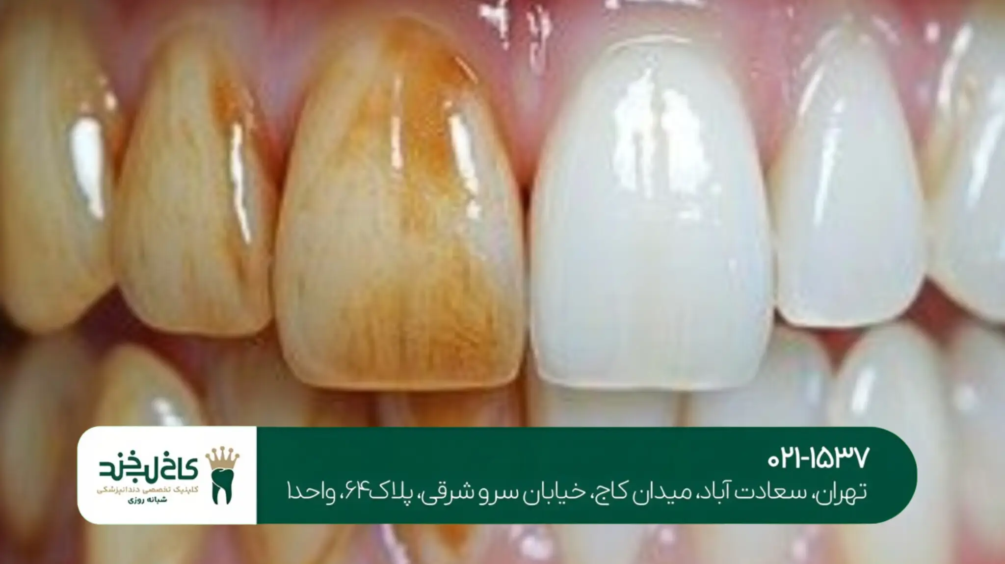 جراحی دندان عقل در شمال تهران