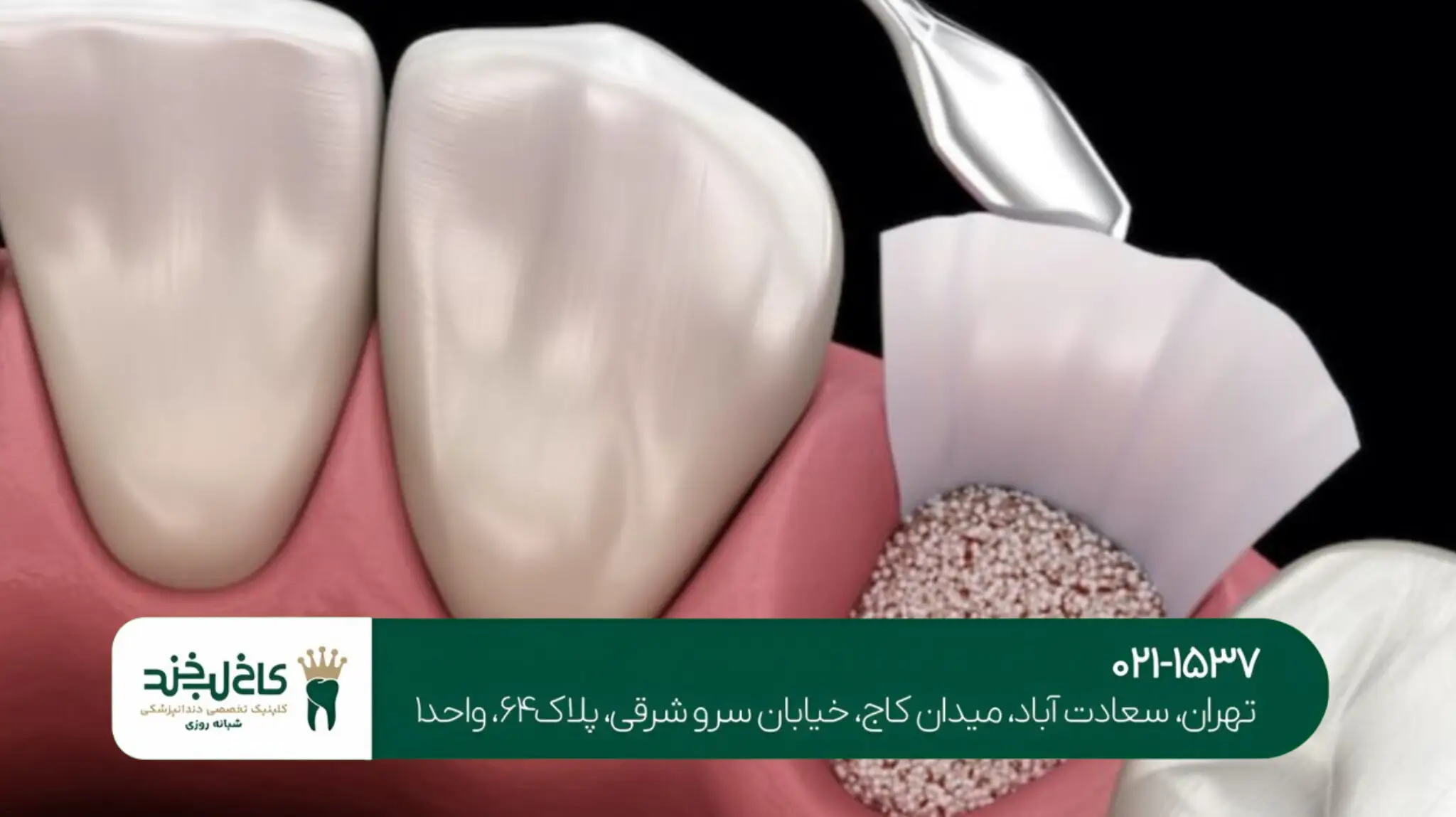 ایمپلنت دندان در یک جلسه روشی