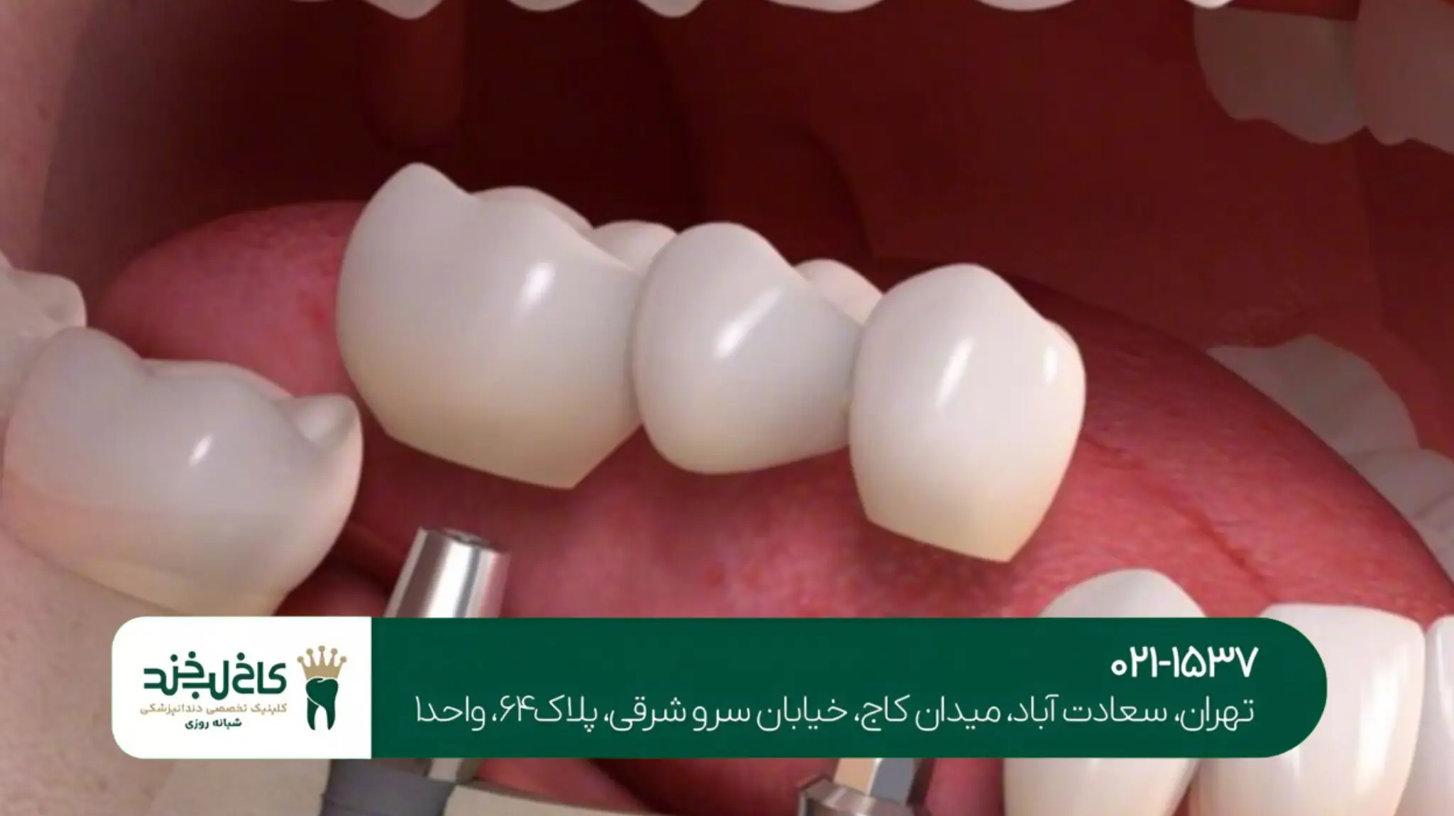 ایمپلنت دندان در یک جلسه روشی