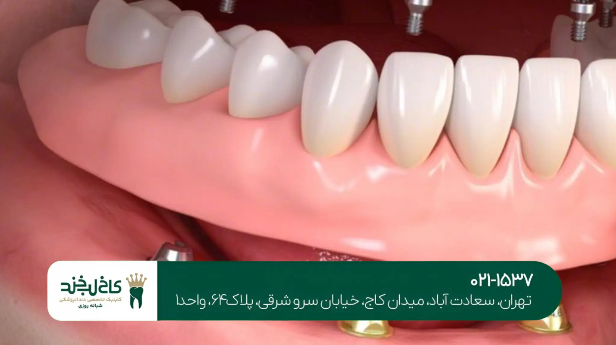 ایمپلنت دندان در یک جلسه روشی