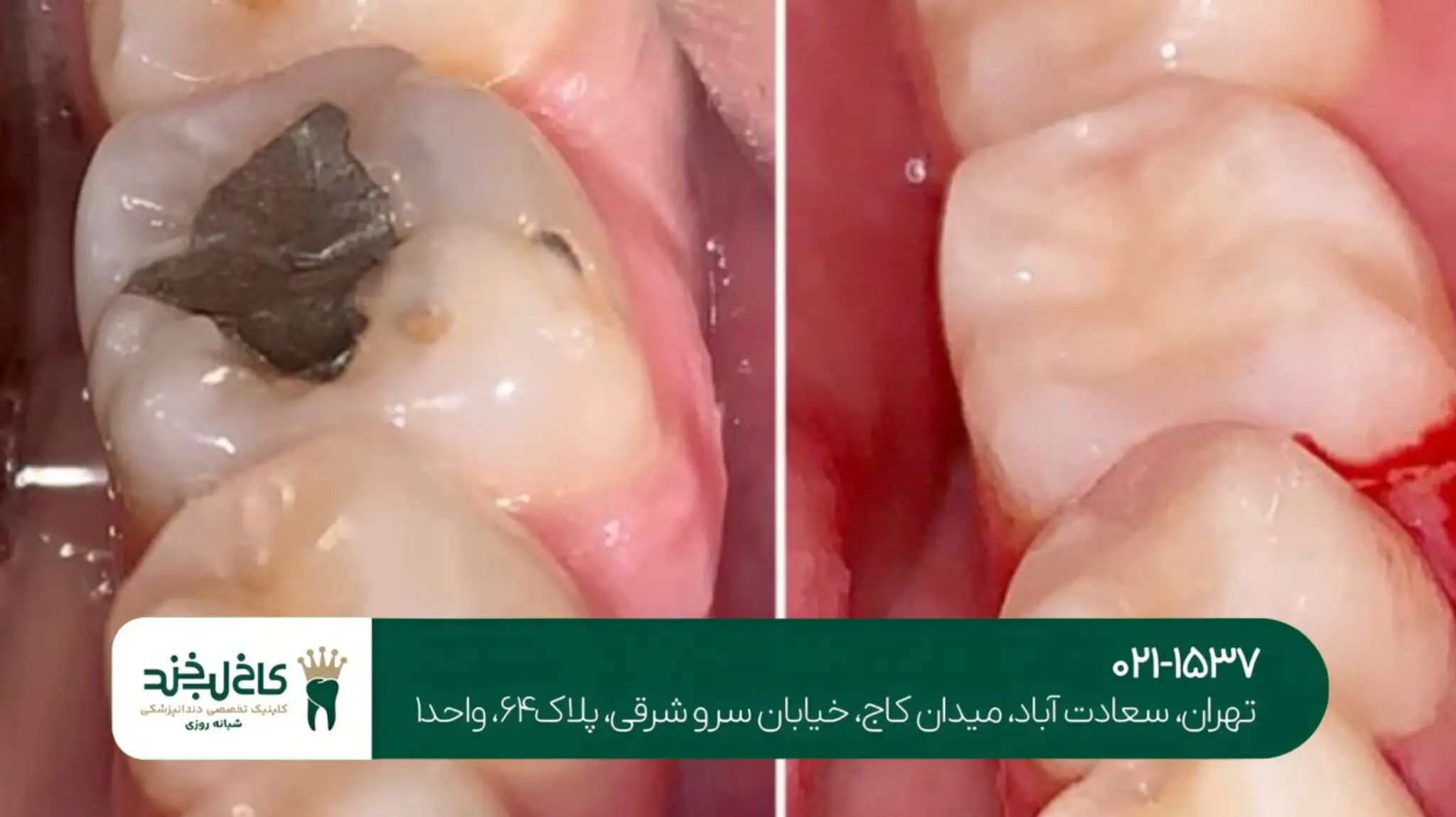 بهترین دندانپزشک کاشت ایمپلنت