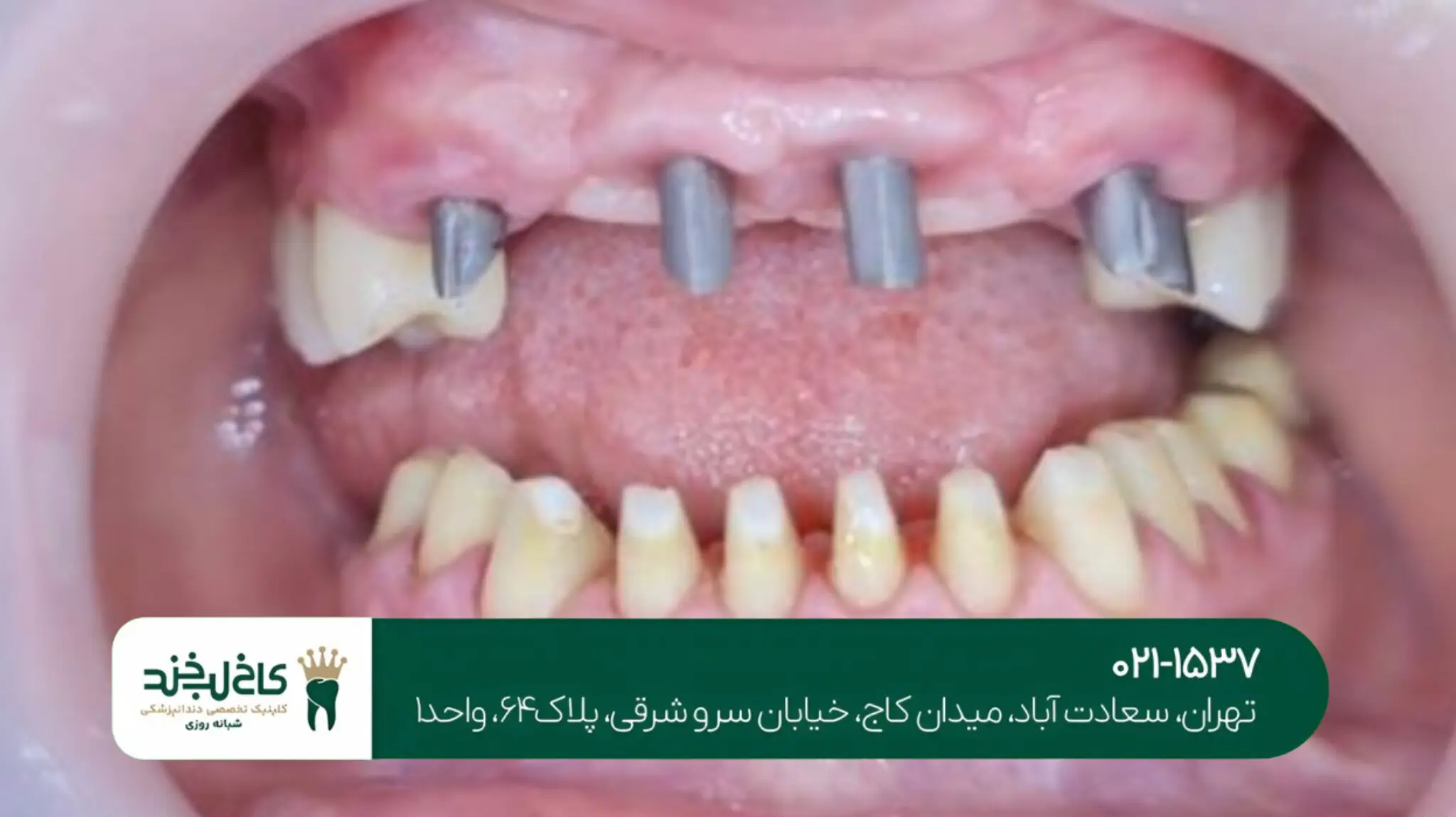 بهترین دندانپزشک کاشت ایمپلنت