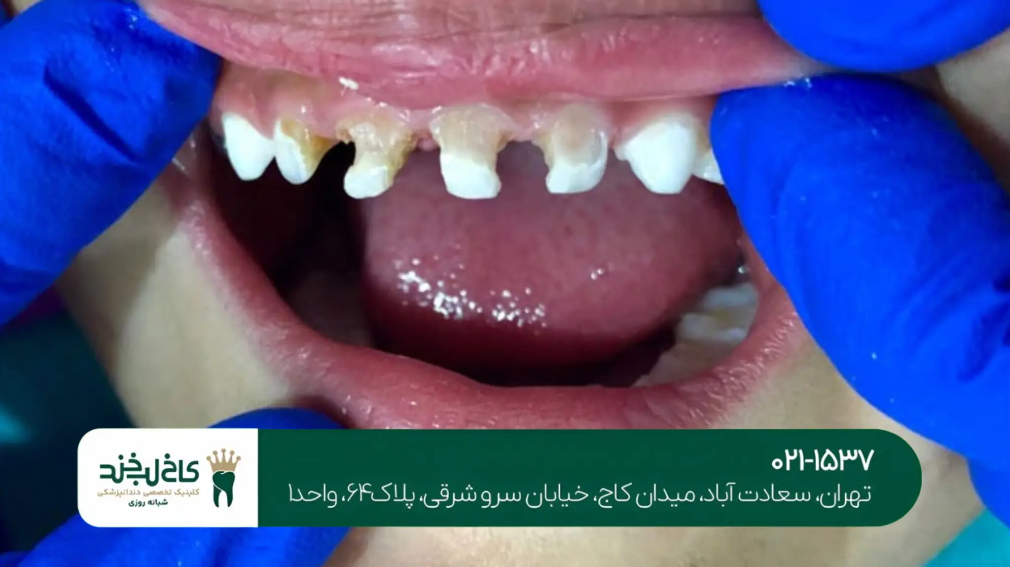 جرم‌گیری دندان‌های زرد