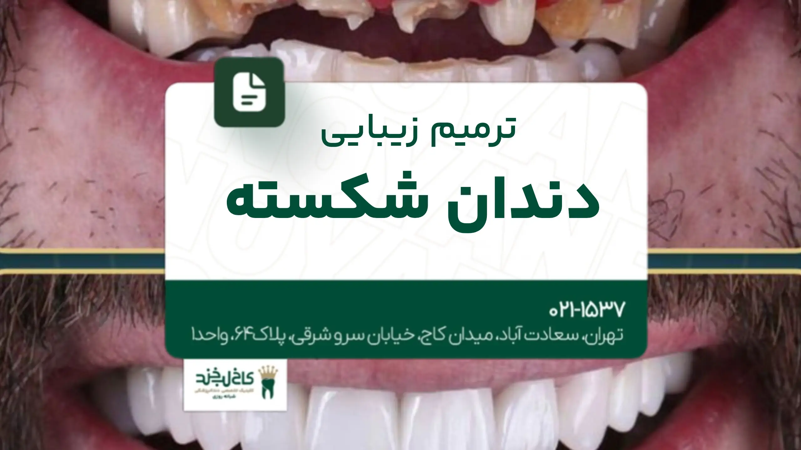 ترمیم زیبایی دندان شکسته