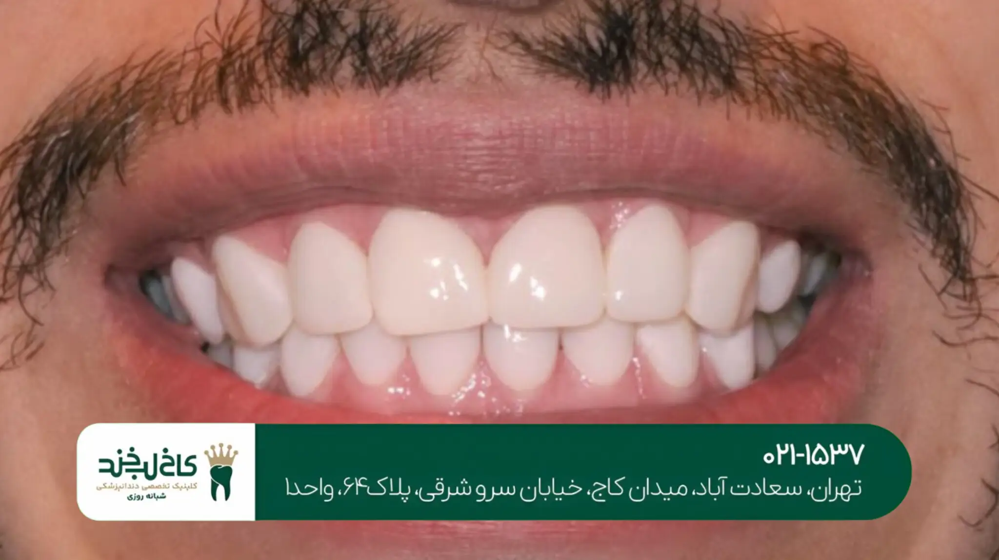 ترمیم زیبایی دندان شکسته