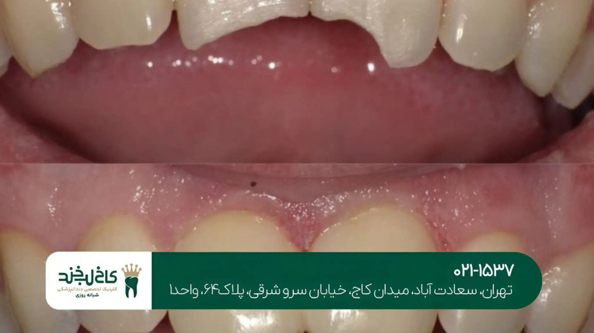 ترمیم زیبایی دندان شکسته