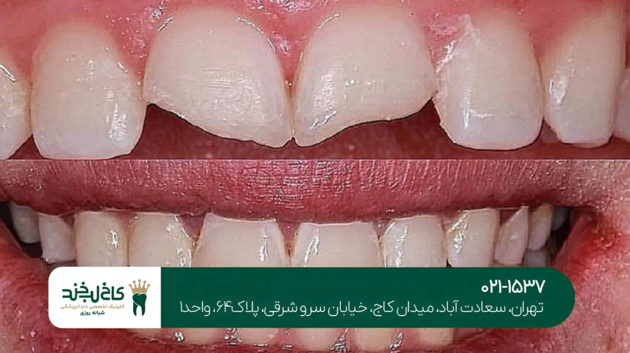 ترمیم زیبایی دندان شکسته