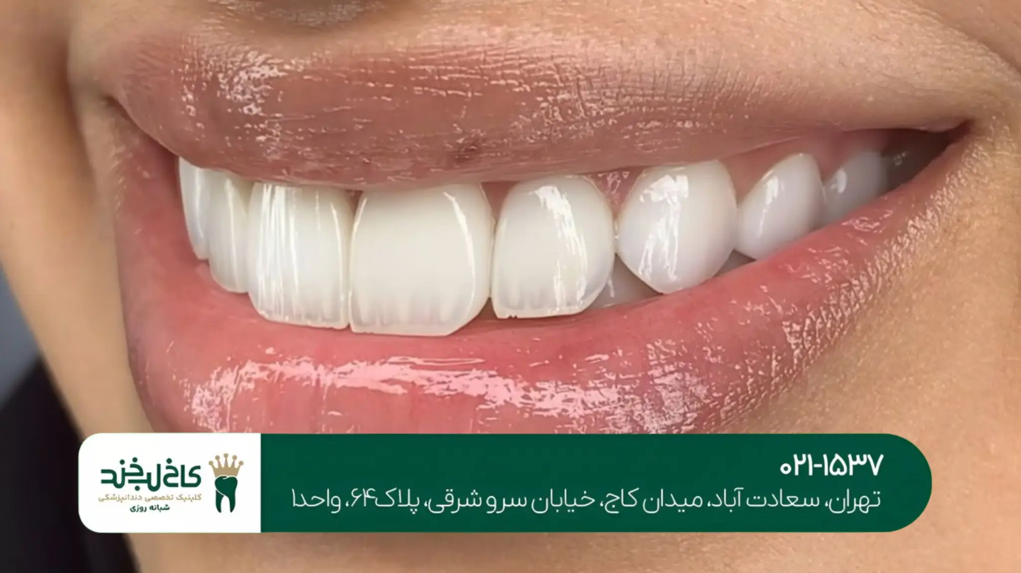 اصلاح لبخند با لمینت سرامیکی 