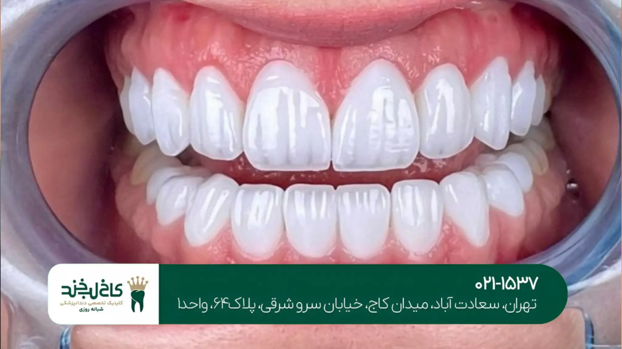 اصلاح لبخند با لمینت سرامیکی 