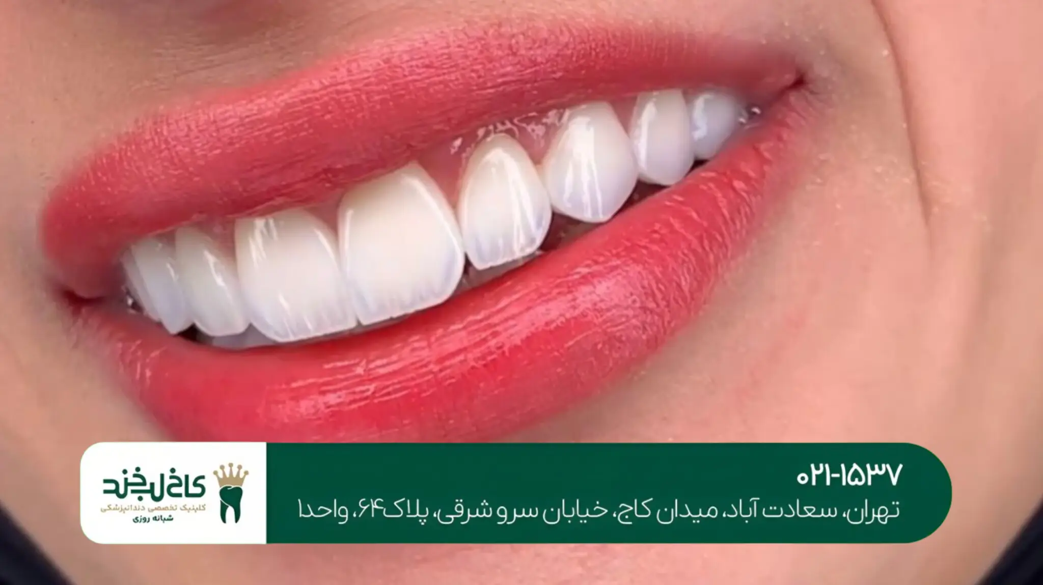 اصلاح لبخند با لمینت سرامیکی 