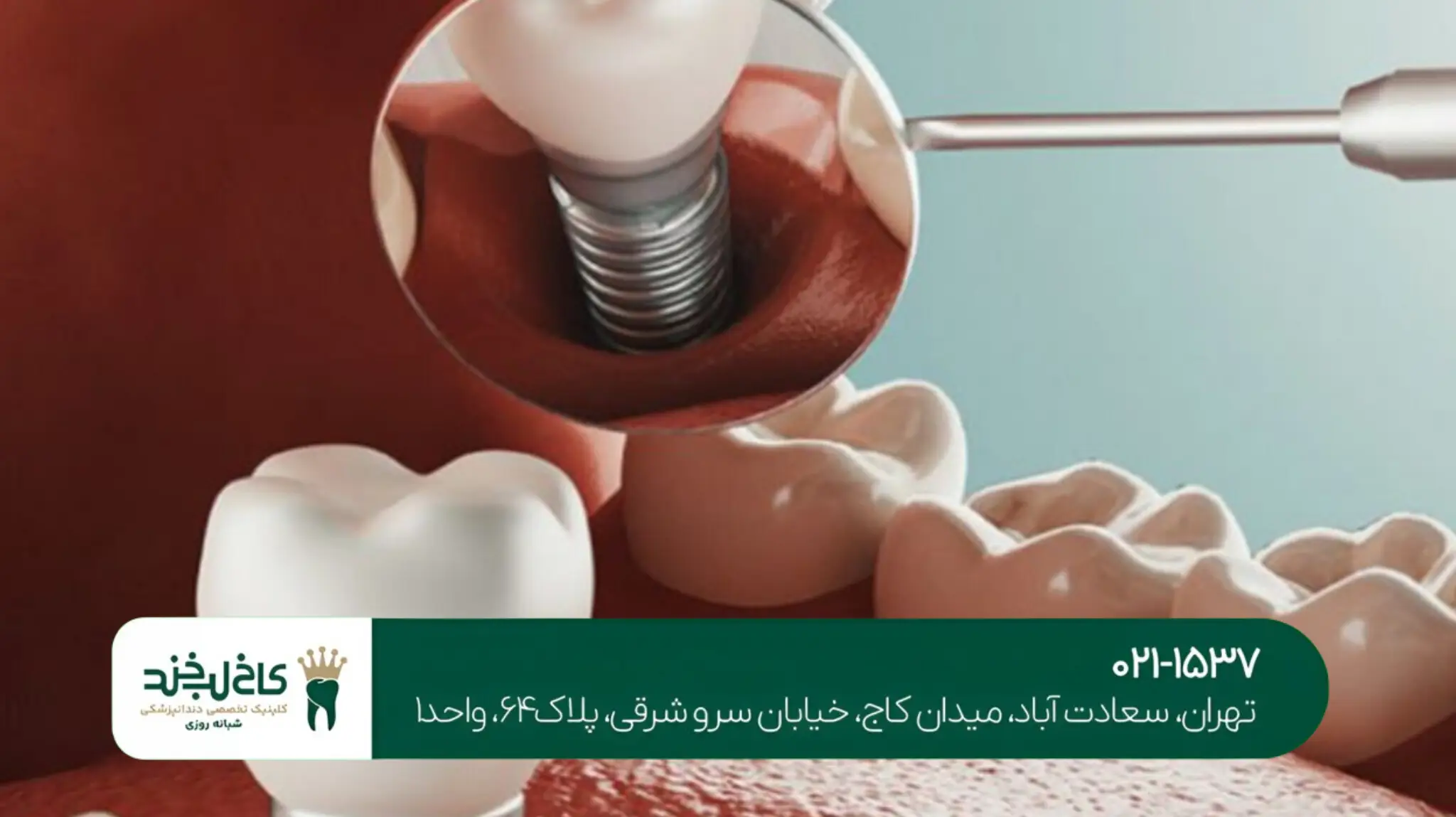 کاشت ایمپلنت با لیزر در تهران