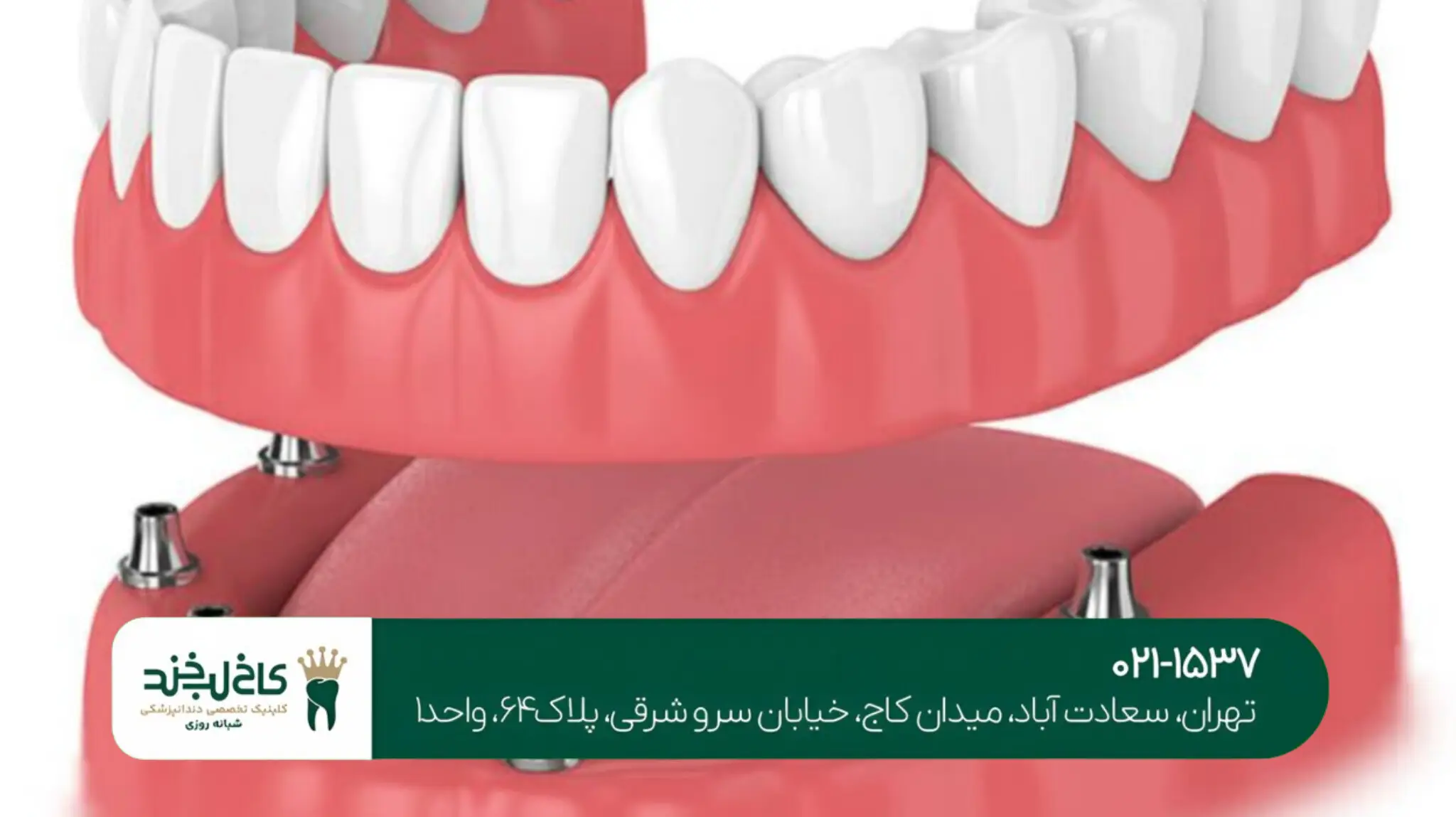 کاشت ایمپلنت با لیزر در تهران