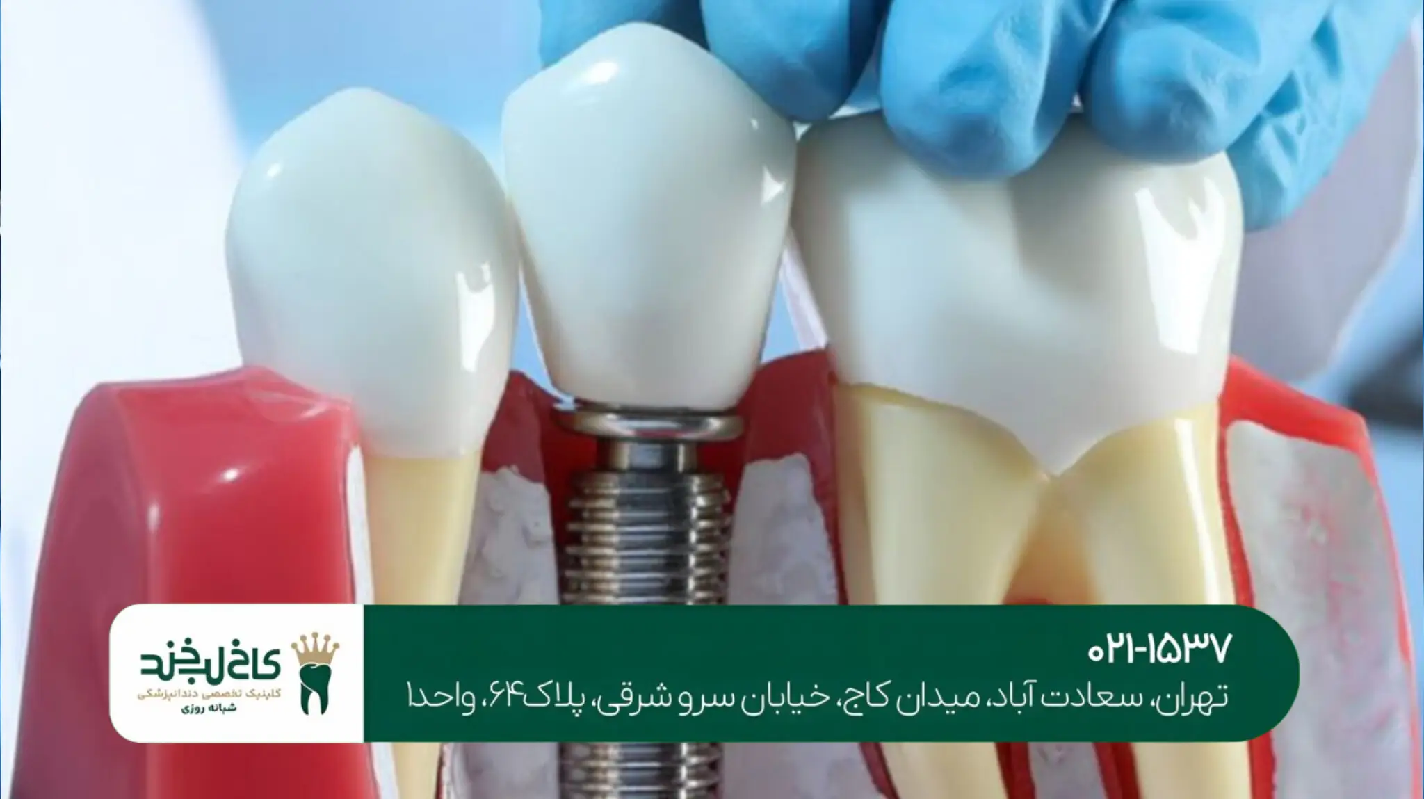 مرکز ایمپلنت دیجیتال کاخ لبخند