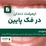 ایمپلنت دندان در فک پایین