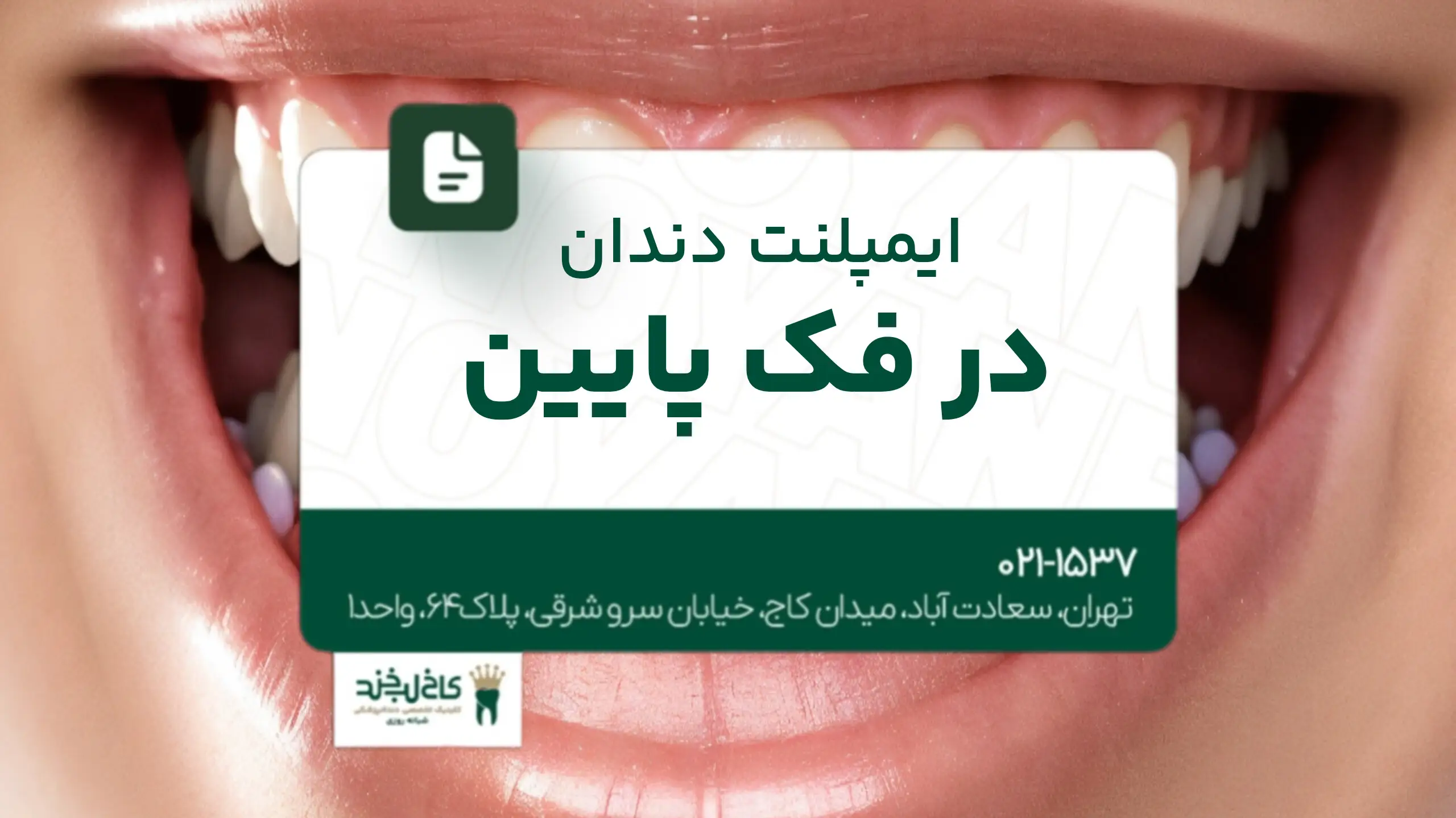 ایمپلنت دندان در فک پایین