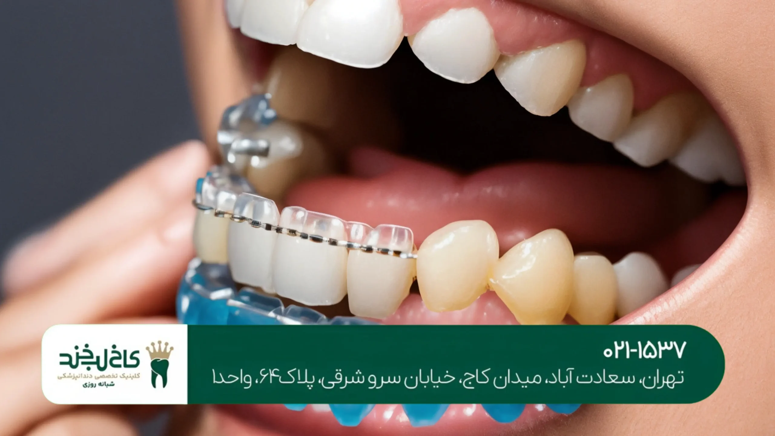 بهترین برند ایمپلنت دندان