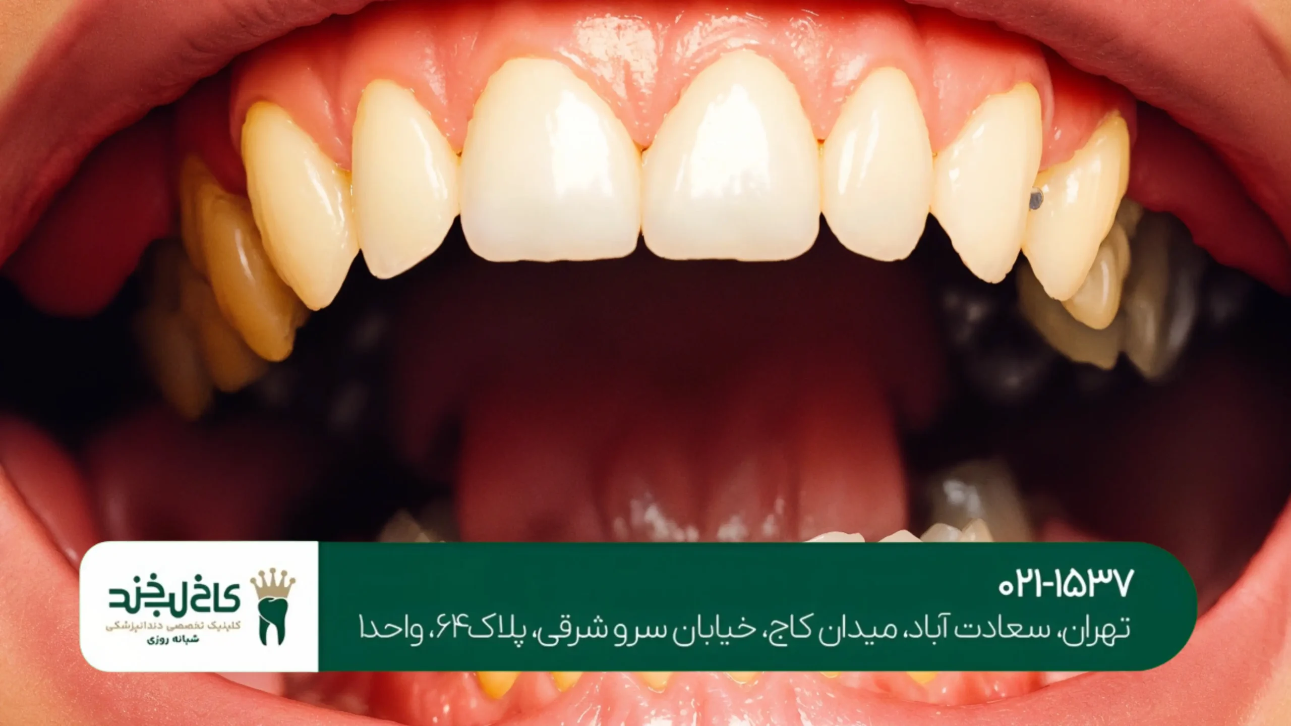 بهترین برند ایمپلنت دندان