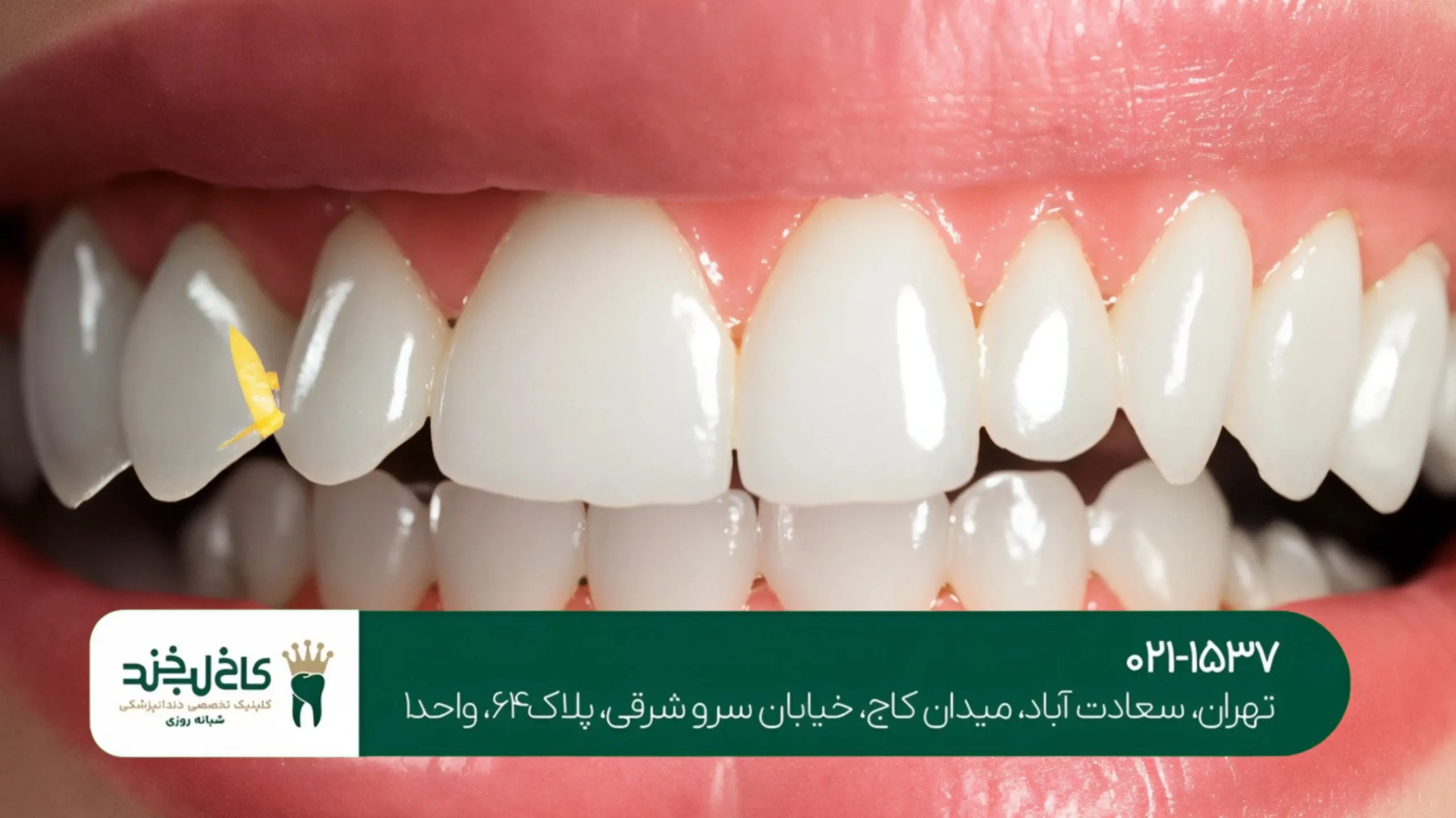 بهترین برند ایمپلنت دندان