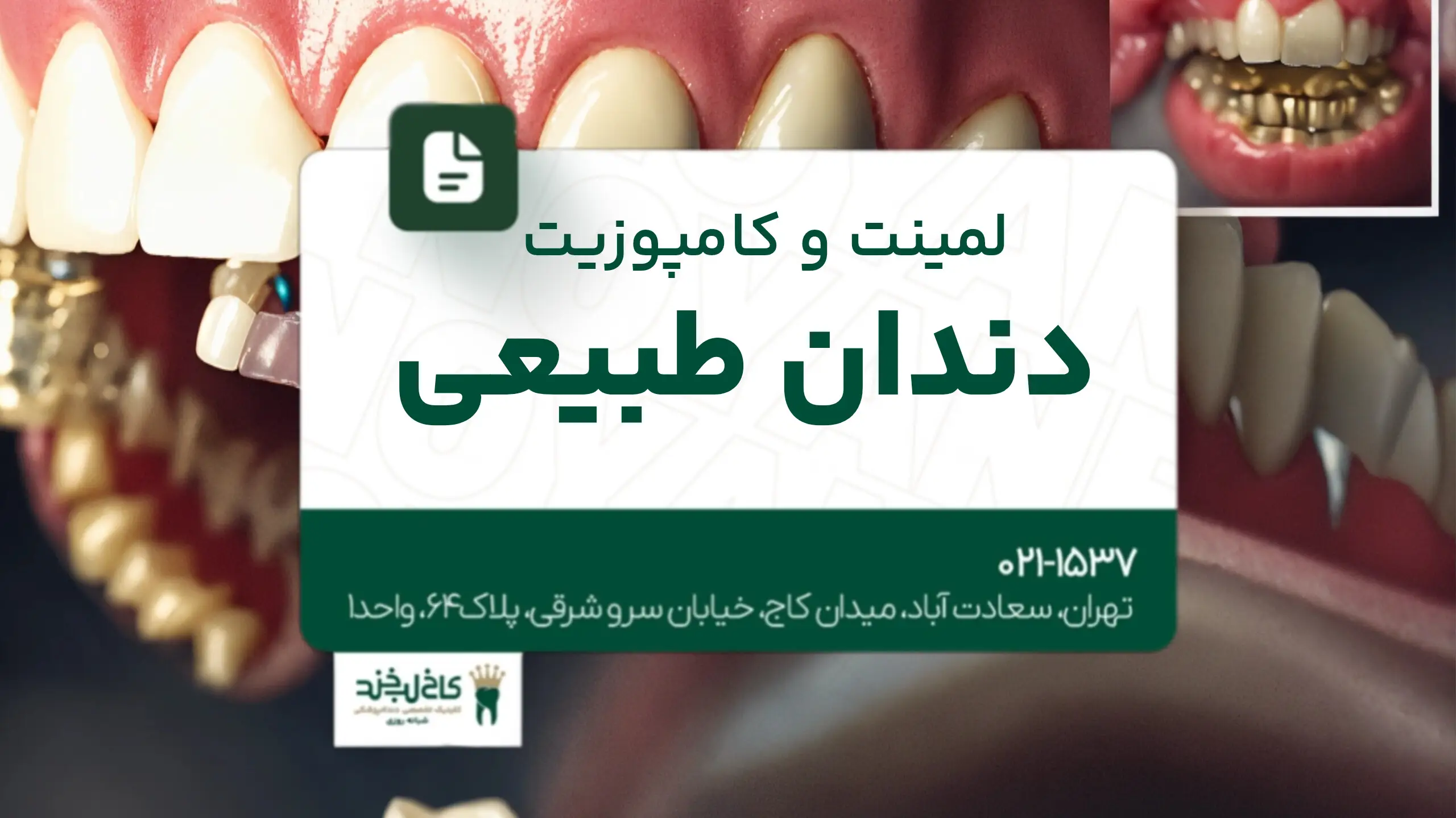 لمینت و کامپوزیت دندان طبیعی