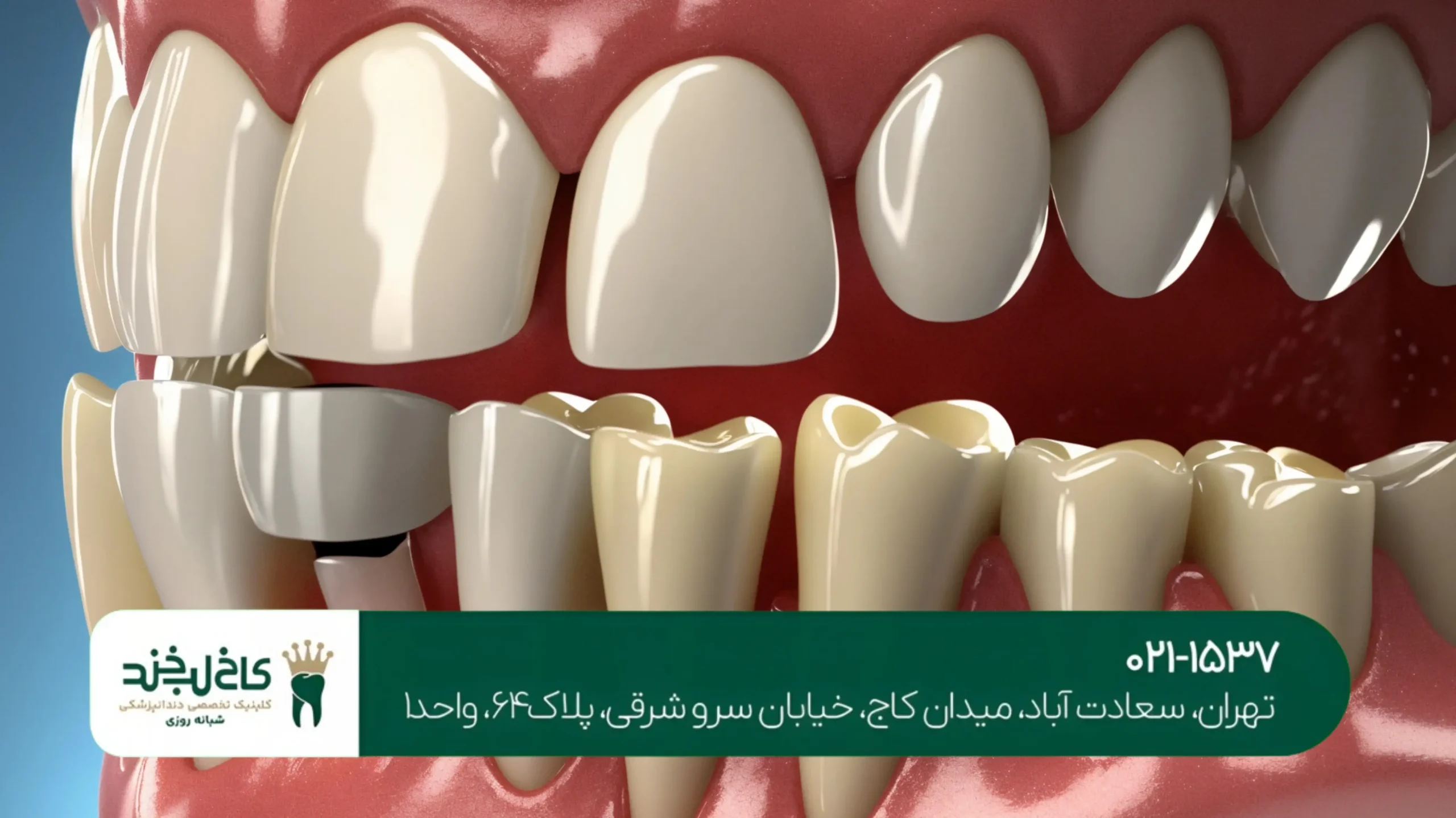 لمینت و کامپوزیت دندان طبیعی