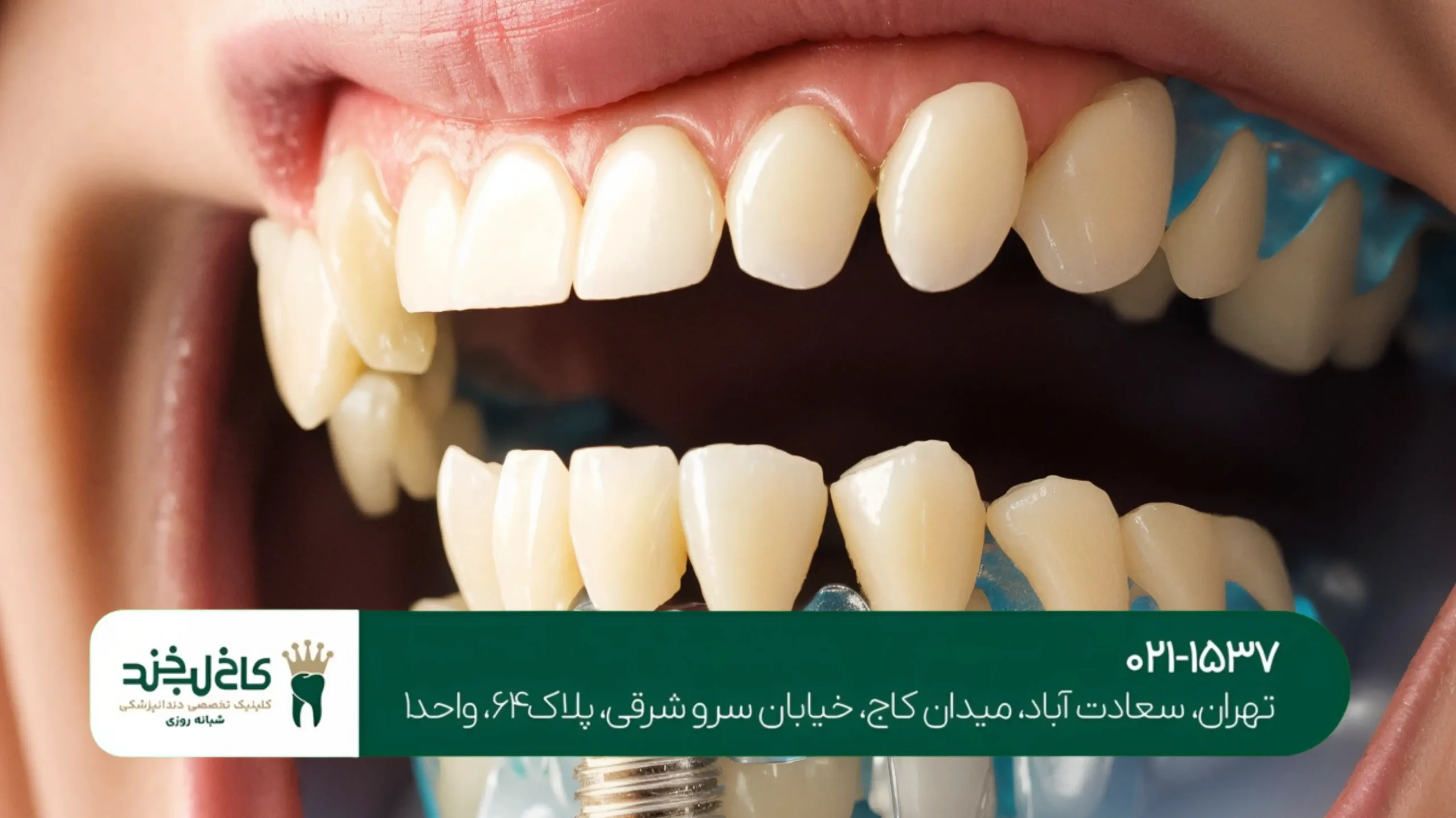 رفع بوی بد دهان با جرم‌گیری