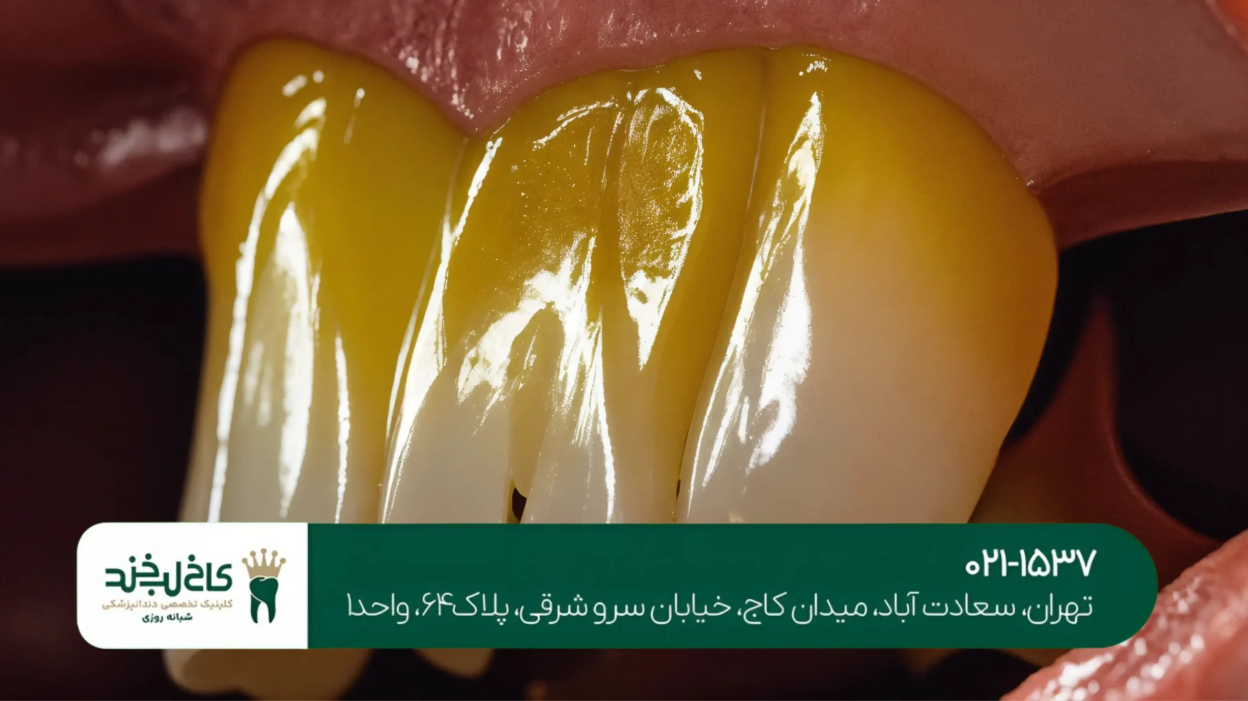 رفع بوی بد دهان با جرم‌گیری