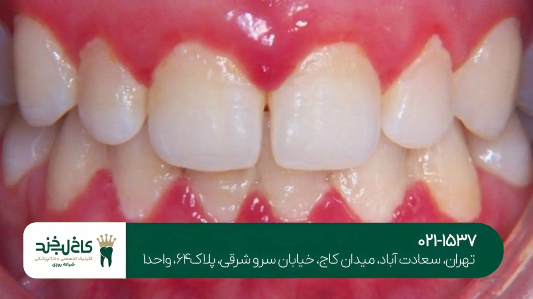 جراحی زیبایی لثه در تهران