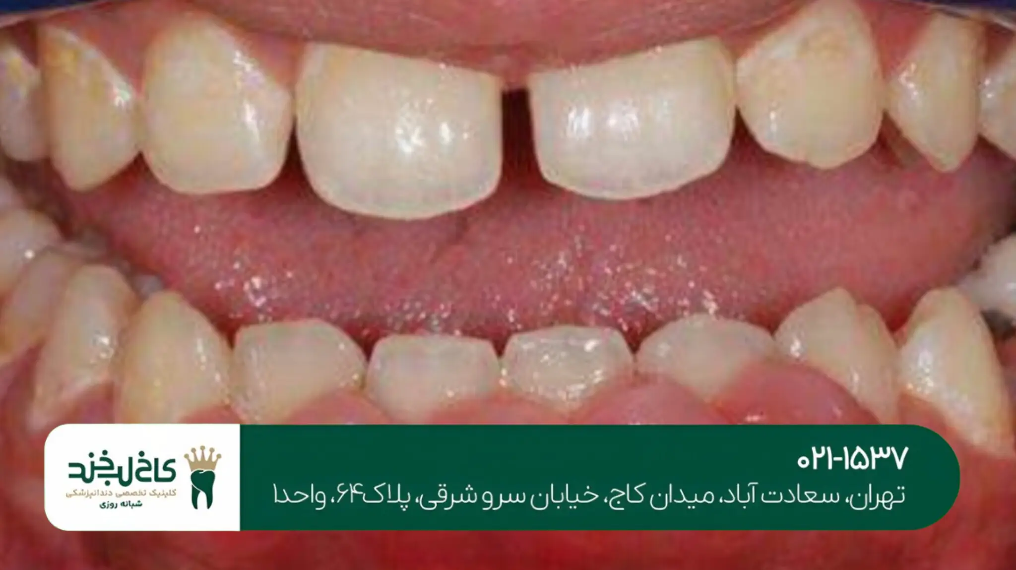 جراحی زیبایی لثه در تهران