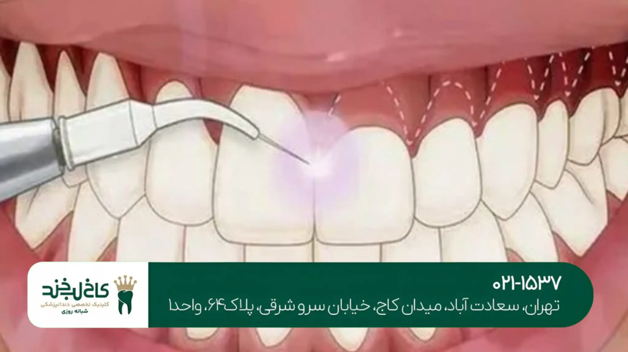 جراحی زیبایی لثه در تهران
