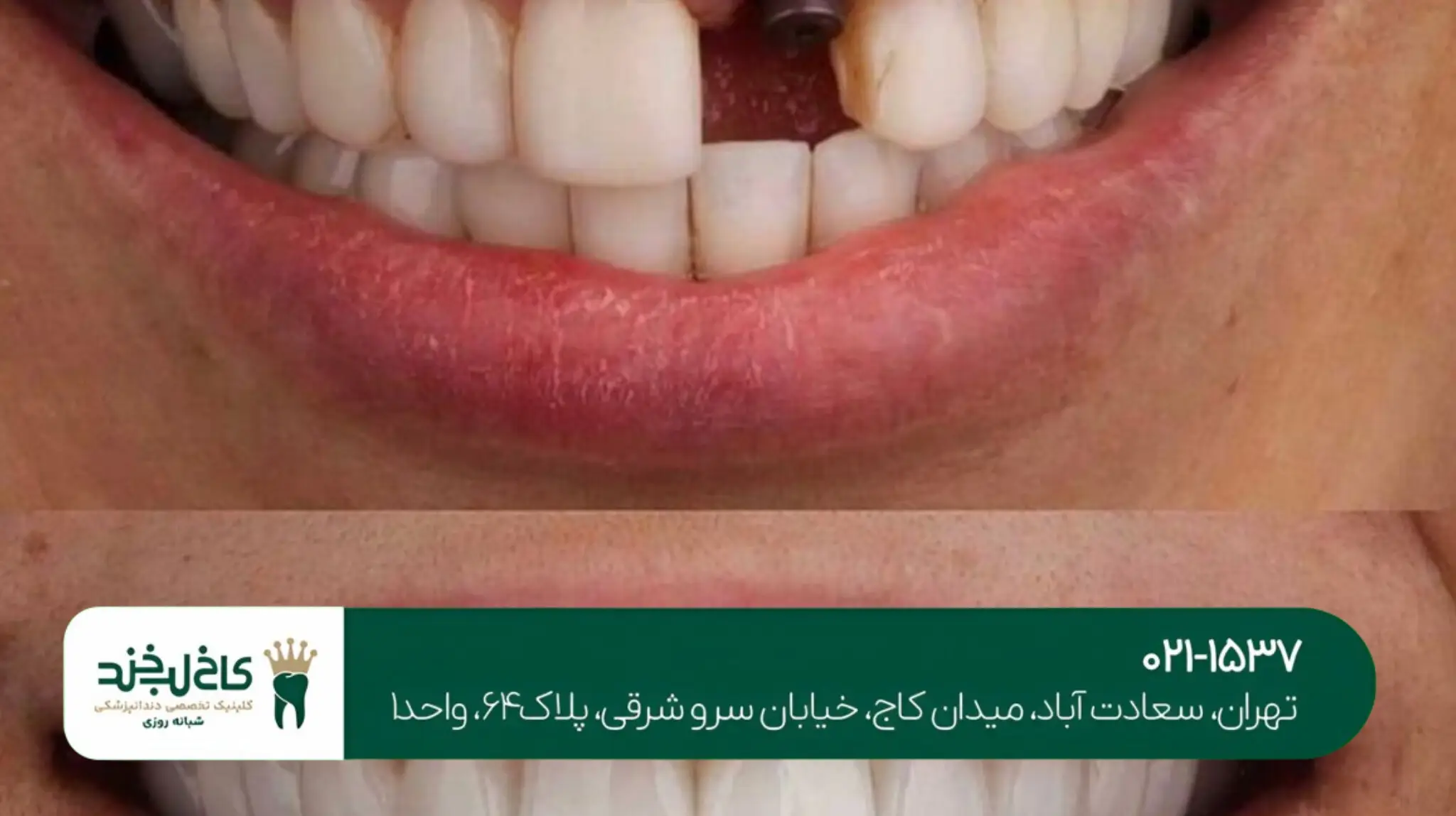 کلینیک کاشت دندان جلو