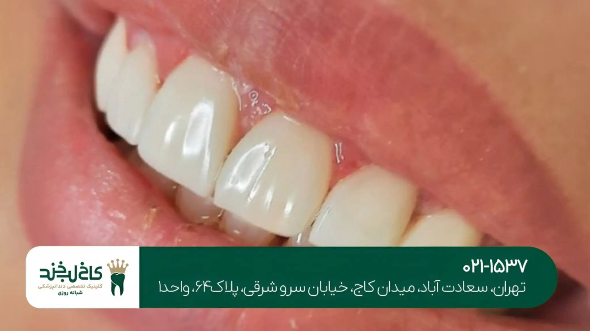 کلینیک کاشت دندان جلو