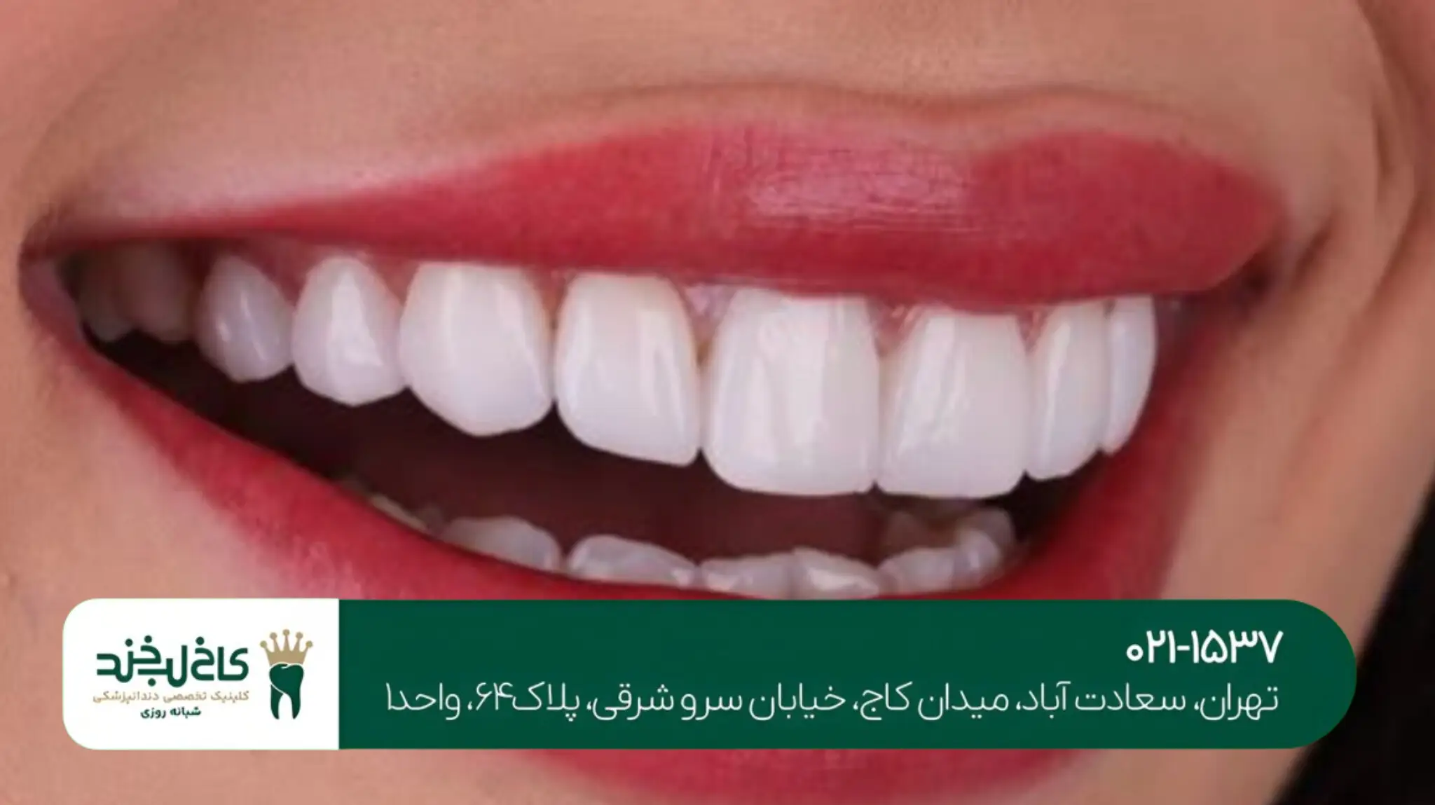 کلینیک کاشت دندان جلو