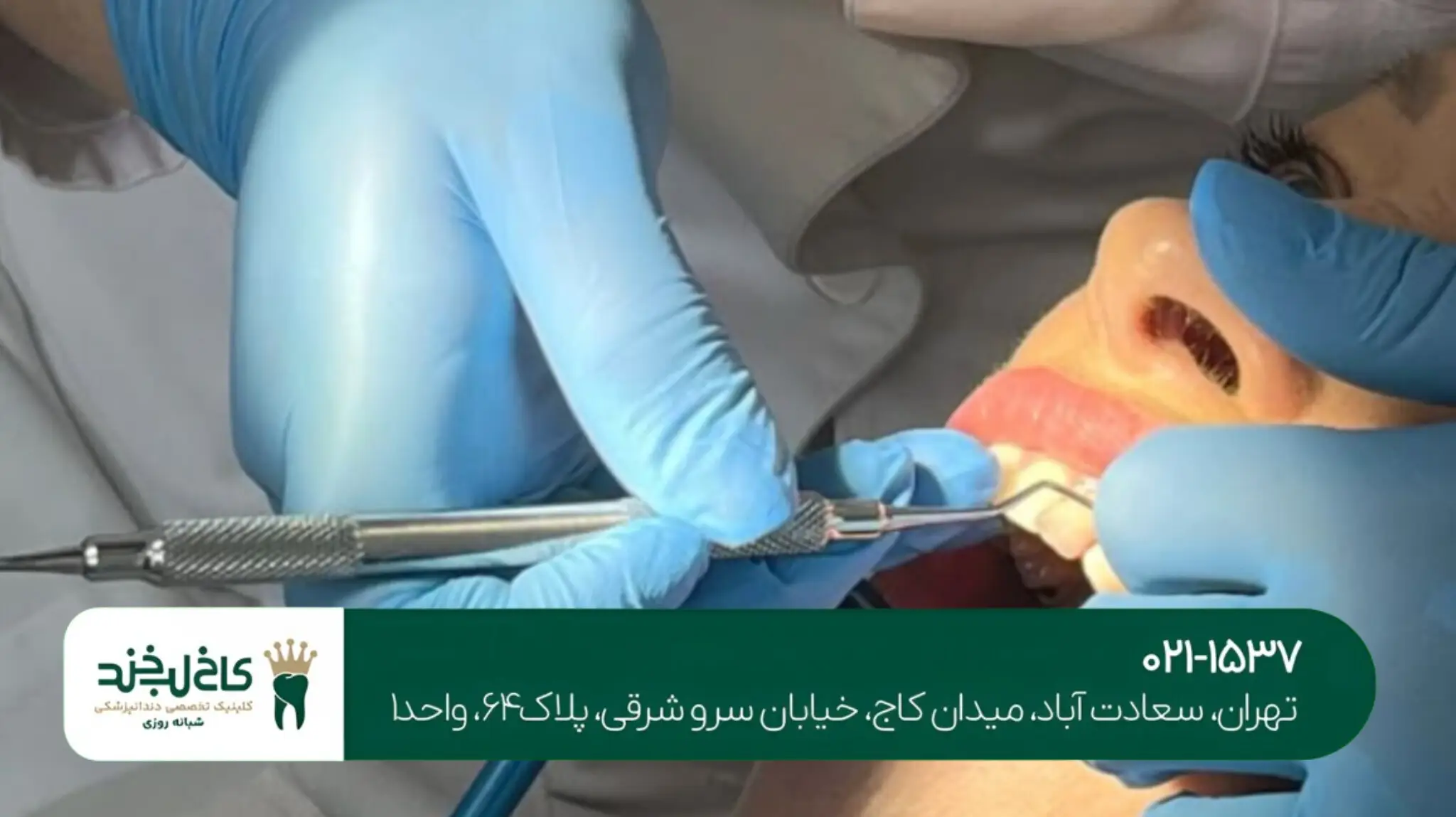 درمان دندان ترکخورده