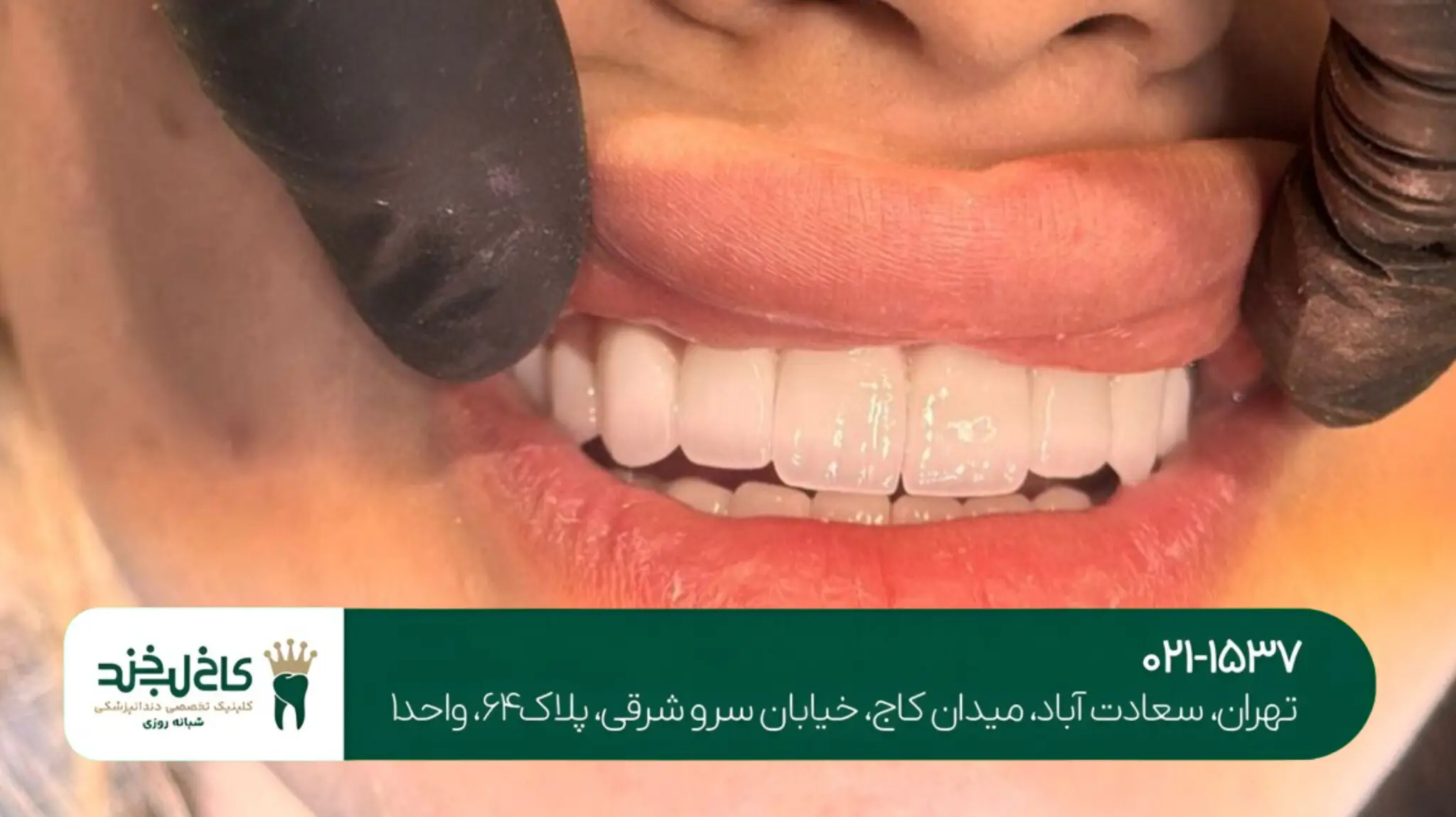 درمان دندان ترکخورده