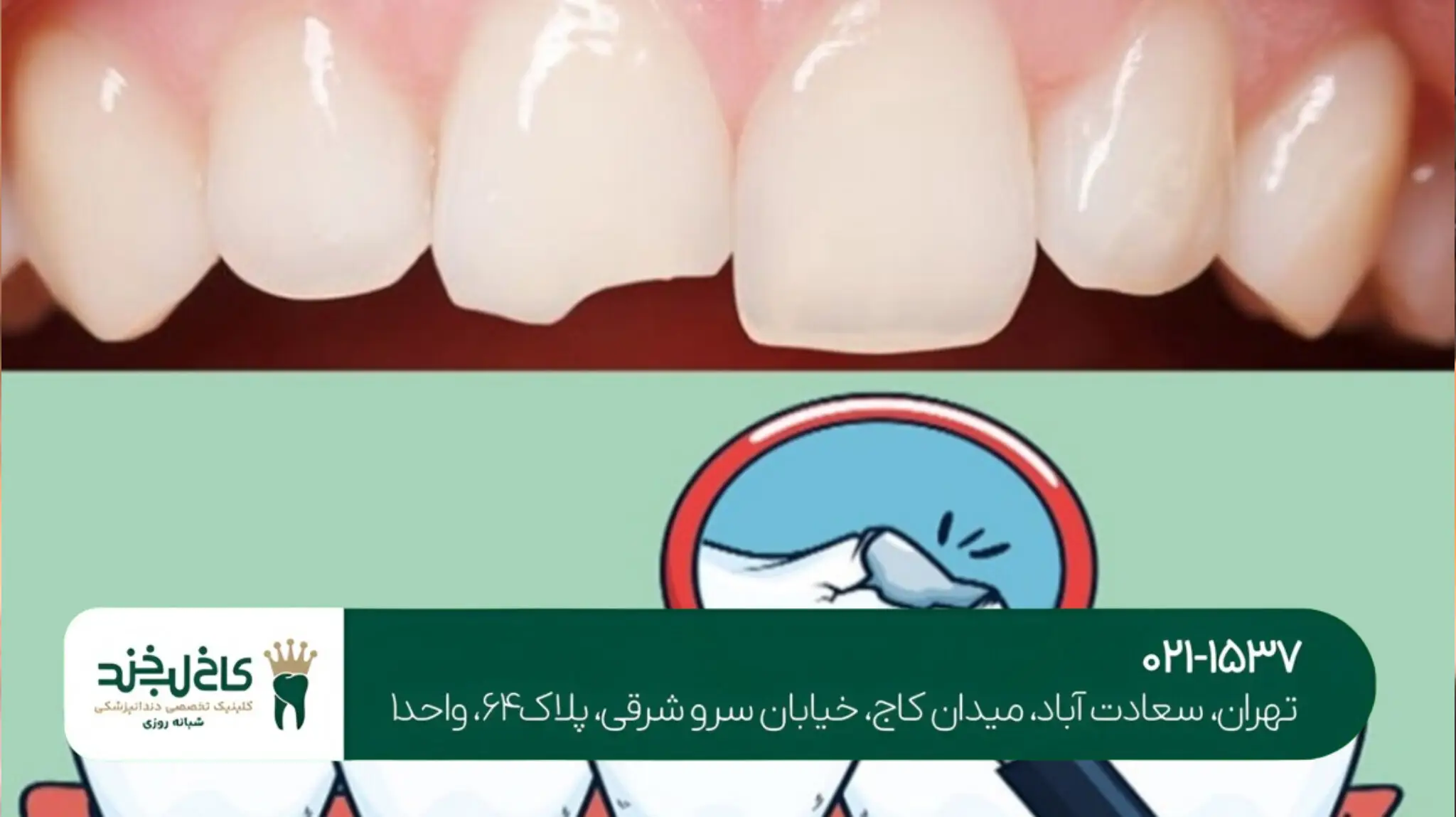 درمان دندان ترکخورده