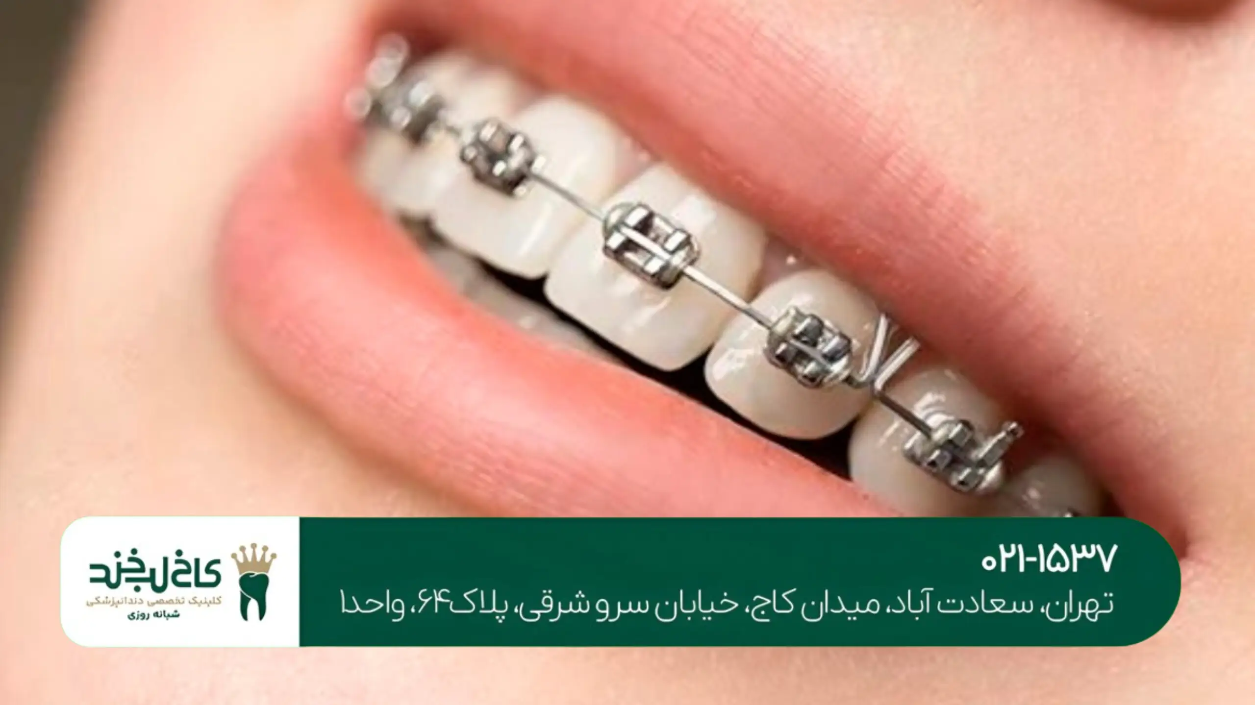 بلیچینگ تخصصی در شمال تهران