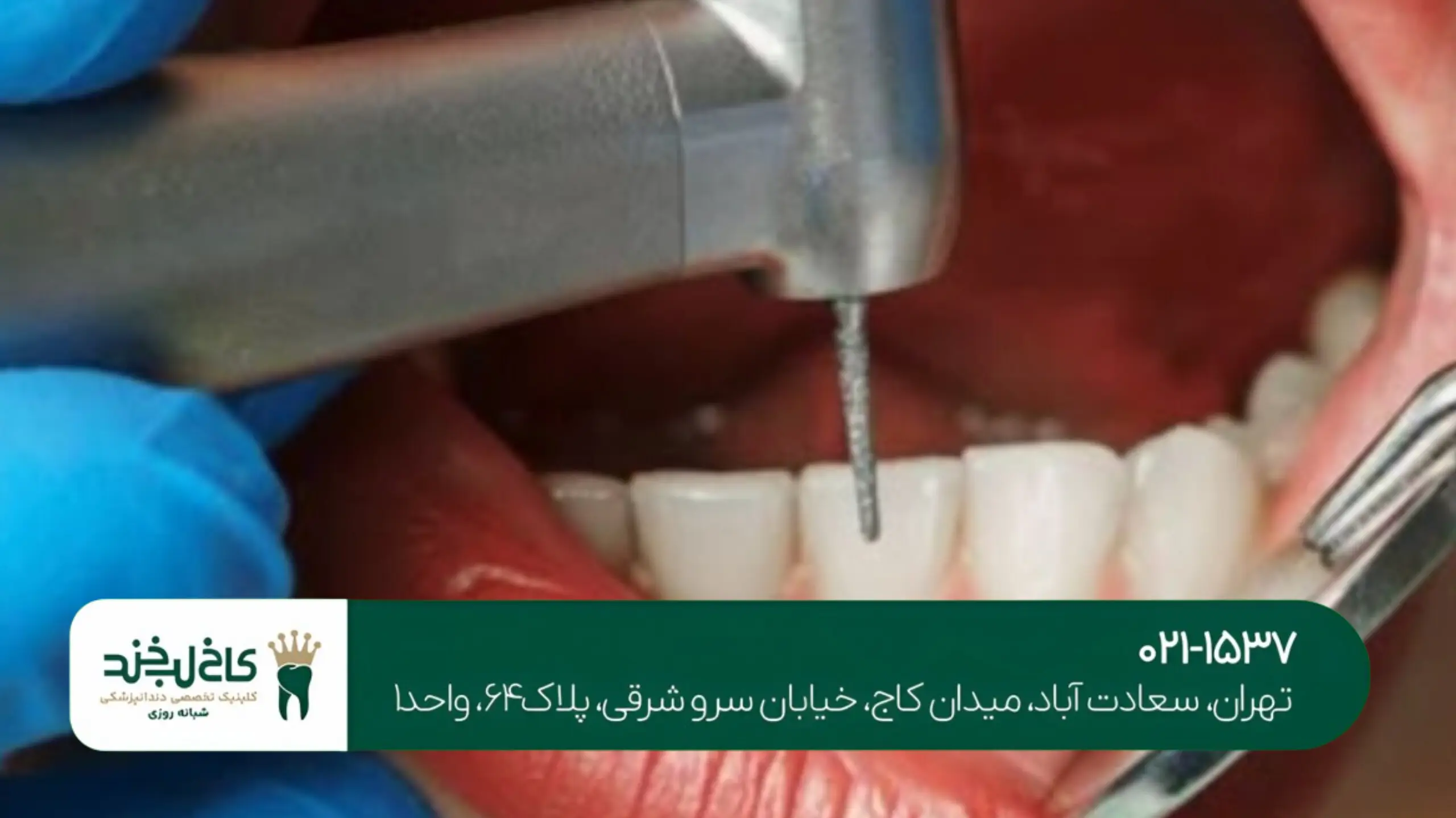 کاشت دندان با گارانتی