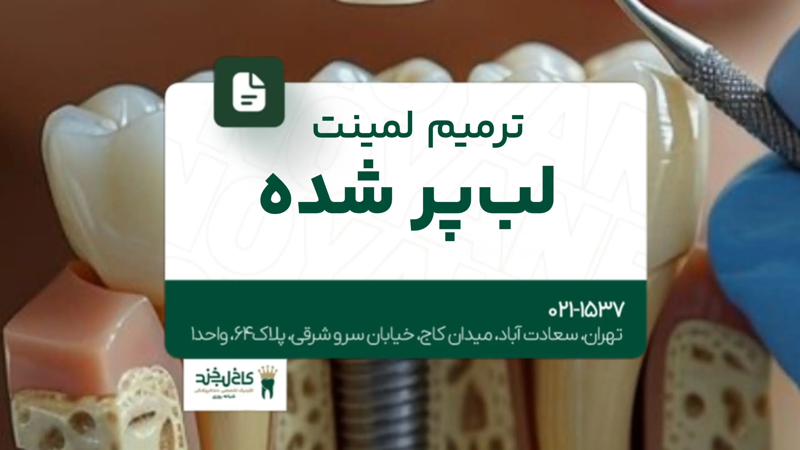 ترمیم لمینت لبپر شده